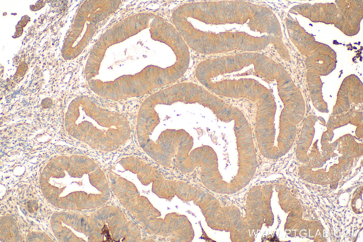 Immunohistochemistry (IHC) staining of human colon  cancer using KRT80 Polyclonal antibody (16835-1-AP)