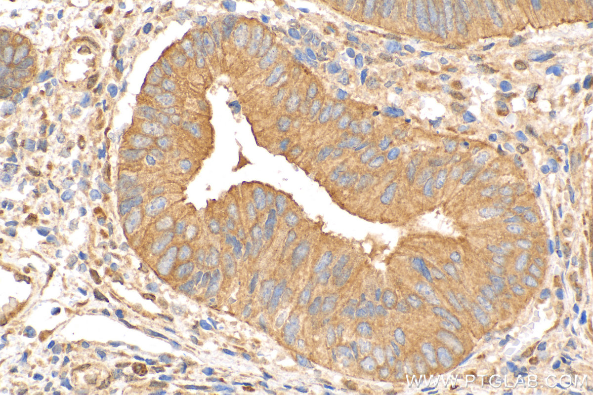 Immunohistochemistry (IHC) staining of human colon  cancer using KRT80 Polyclonal antibody (16835-1-AP)