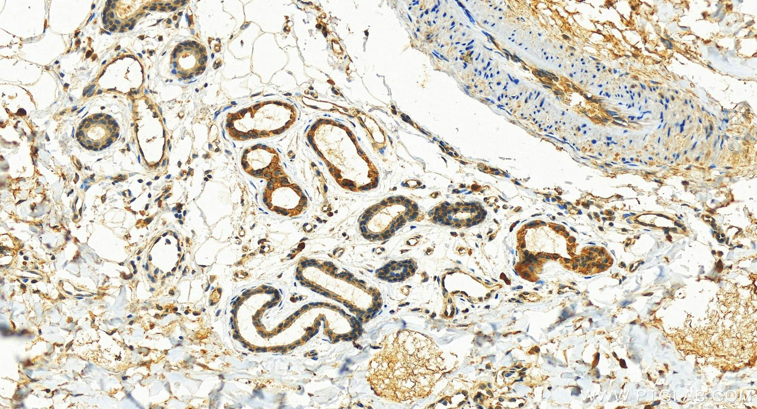 Immunohistochemistry (IHC) staining of human bowen disease using KRT80 Polyclonal antibody (16835-1-AP)