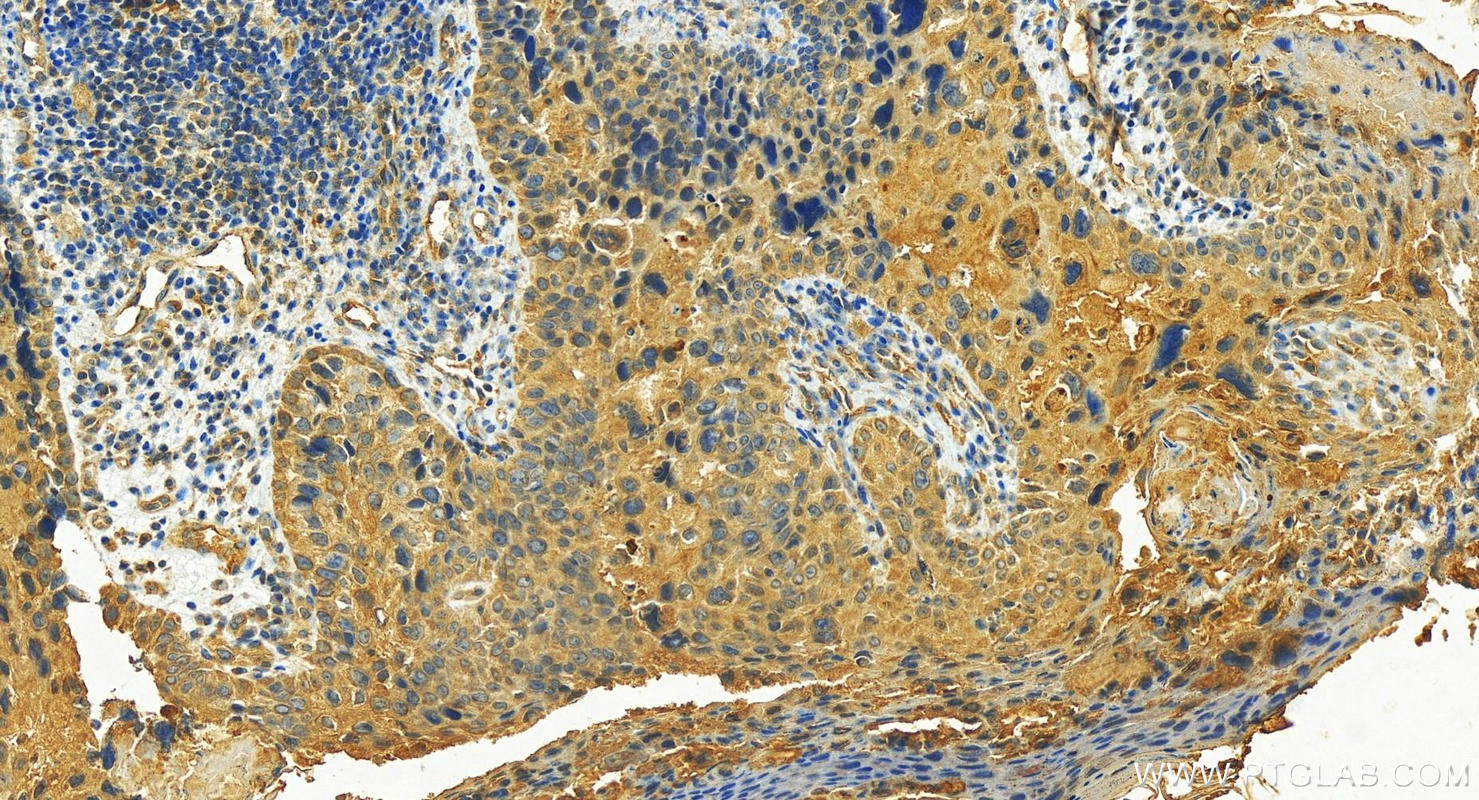 Immunohistochemistry (IHC) staining of human bowen disease using KRT80 Polyclonal antibody (16835-1-AP)