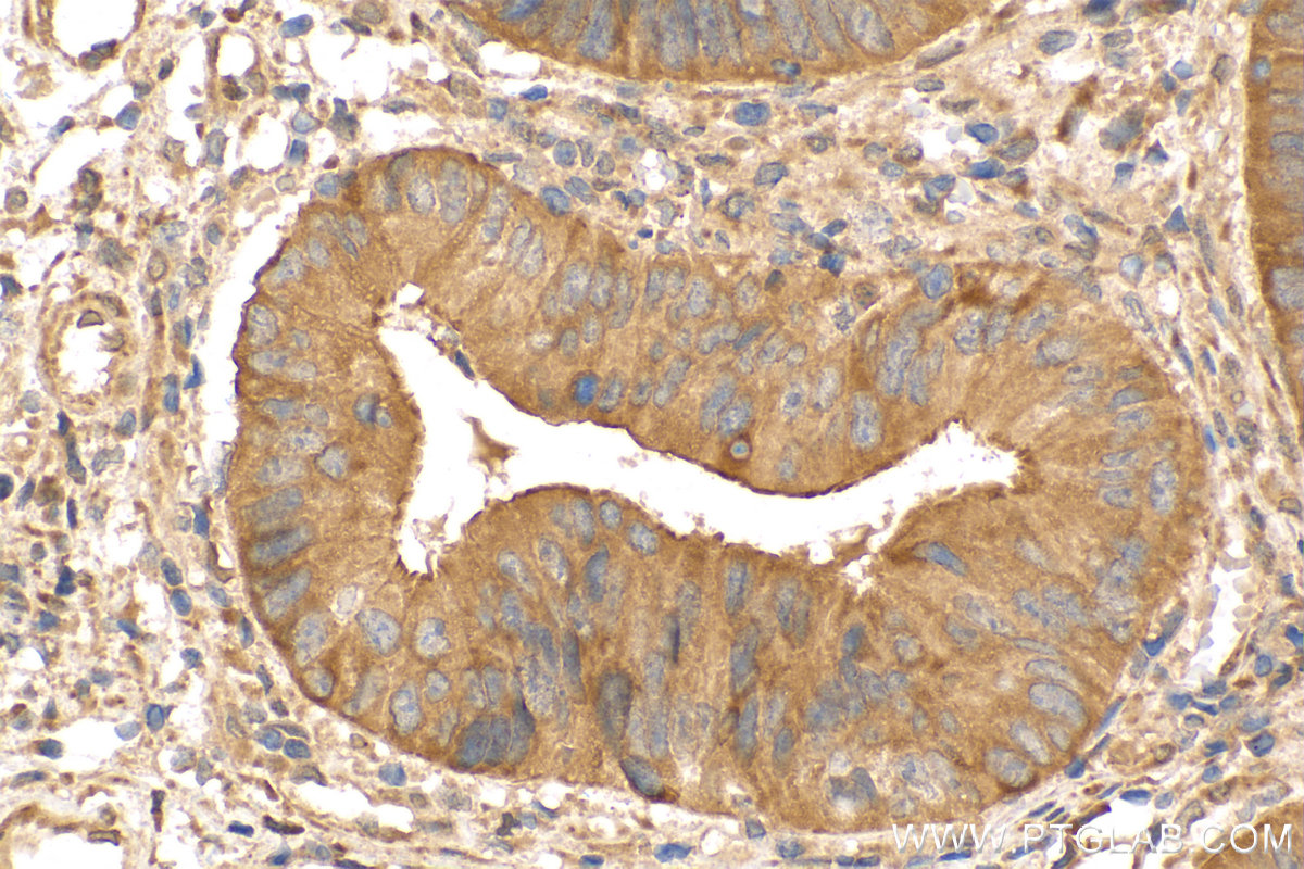 Immunohistochemistry (IHC) staining of human colon  cancer using Biotin-conjugated KRT80 Polyclonal antibody (Biotin-16835)