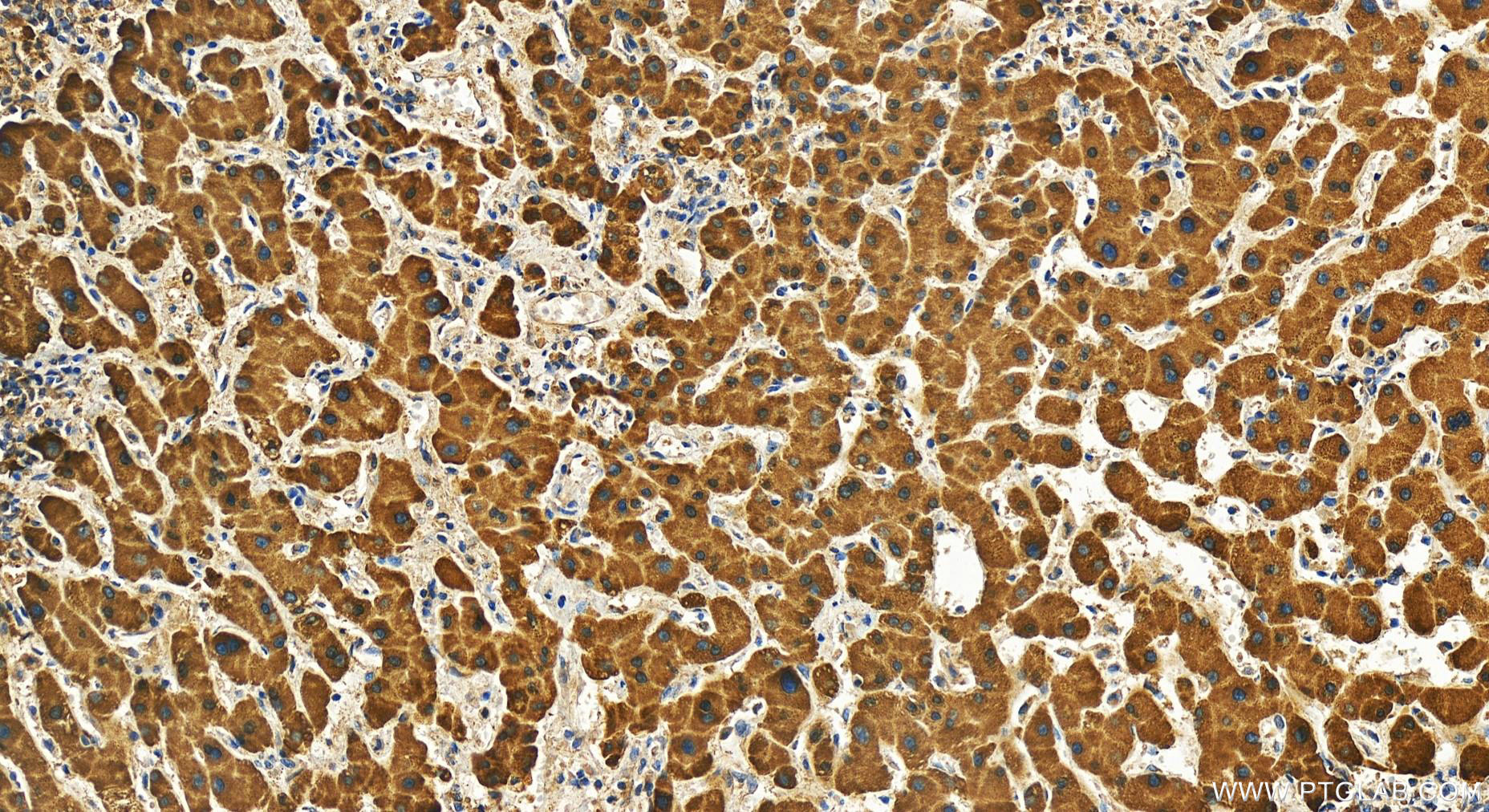 Immunohistochemistry (IHC) staining of human intrahepatic cholangiocarcinoma tissue using KTI12 Polyclonal antibody (28237-1-AP)