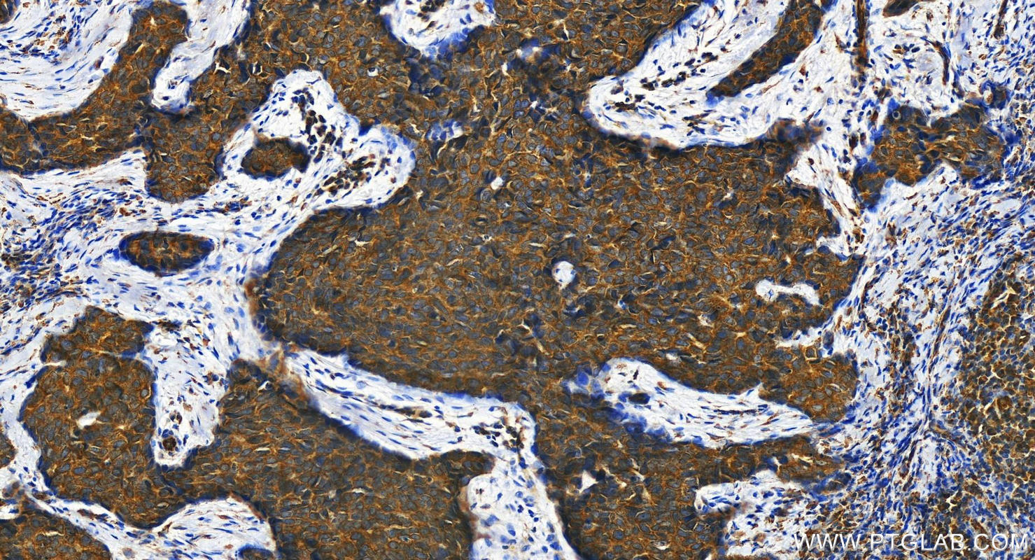 Immunohistochemistry (IHC) staining of human bowen disease using KTN1 Polyclonal antibody (19841-1-AP)