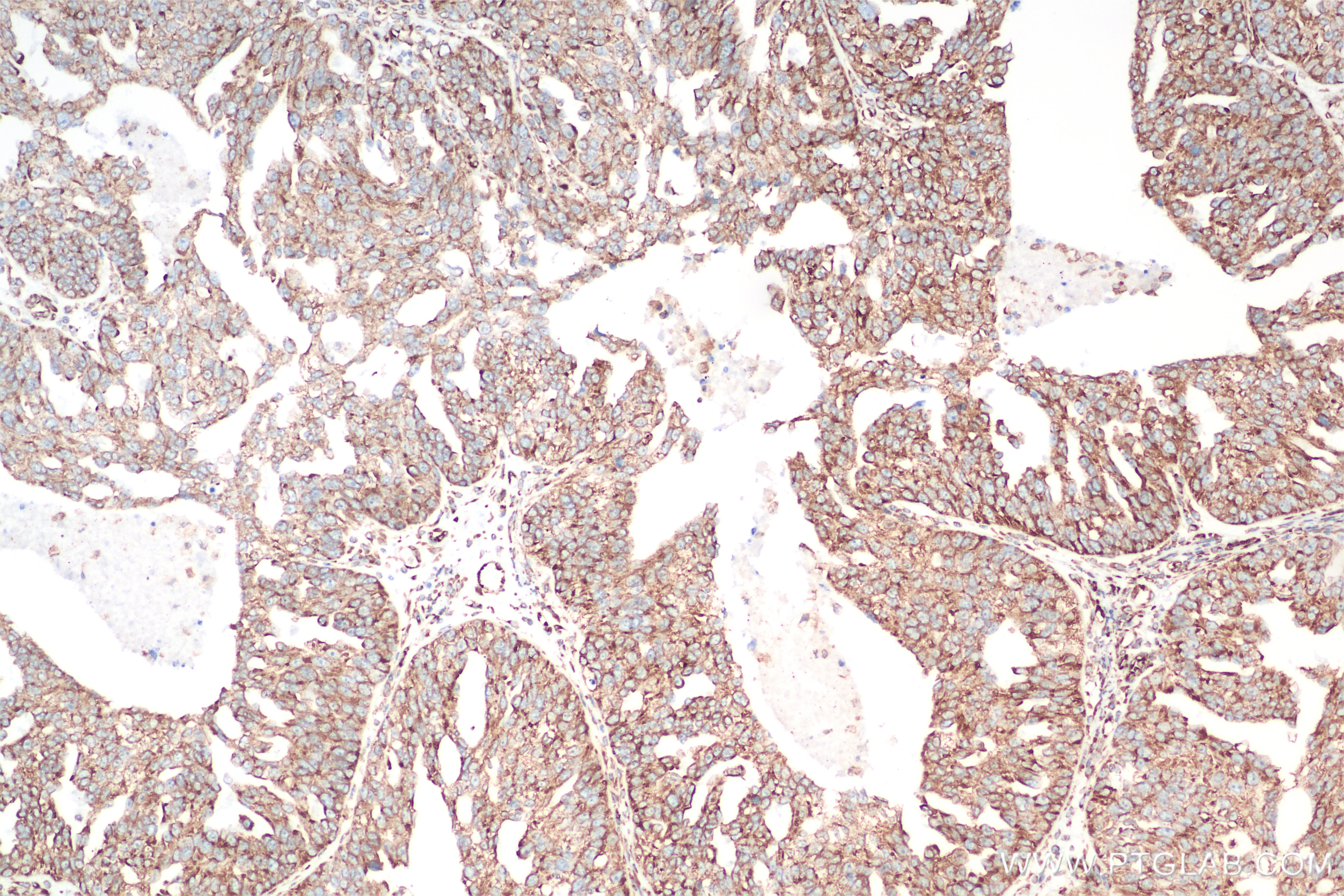 Immunohistochemistry (IHC) staining of human ovary cancer tissue using KTN1 Recombinant antibody (85681-4-RR)