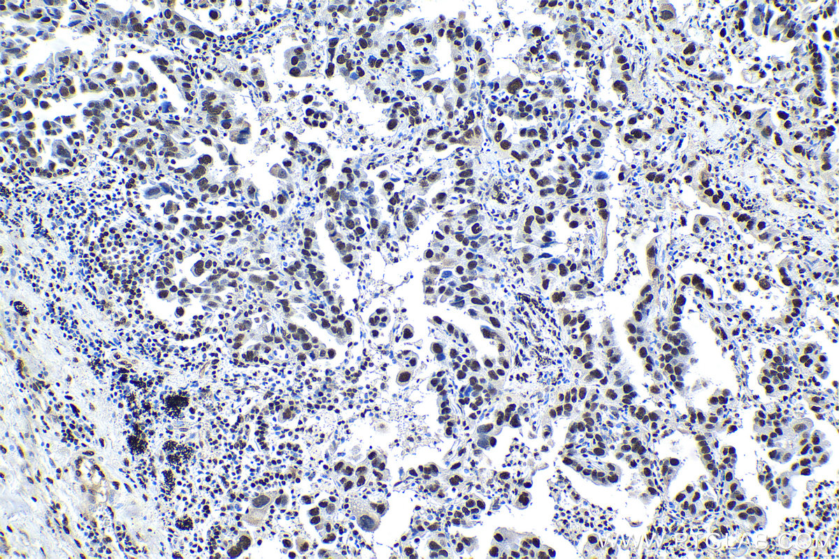 Immunohistochemistry (IHC) staining of human lung cancer tissue using KU70,XRCC6 Polyclonal antibody (10723-1-AP)