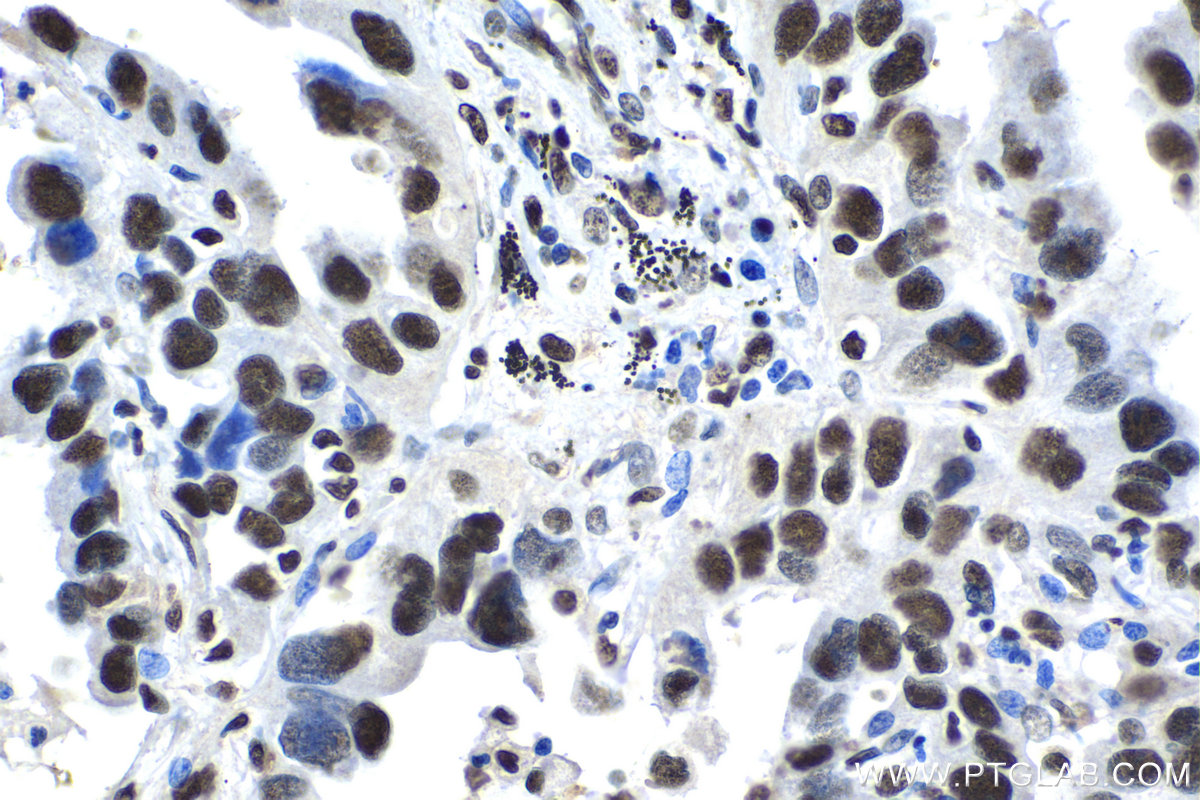 Immunohistochemistry (IHC) staining of human lung cancer tissue using KU70,XRCC6 Polyclonal antibody (10723-1-AP)