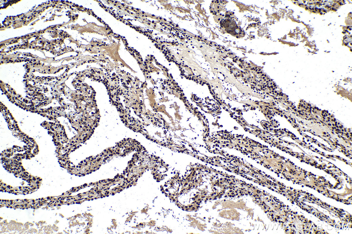 Immunohistochemistry (IHC) staining of human renal cell carcinoma tissue using KU70,XRCC6 Polyclonal antibody (10723-1-AP)