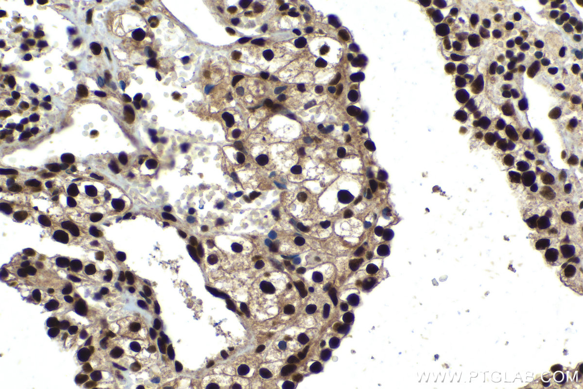 Immunohistochemistry (IHC) staining of human renal cell carcinoma tissue using KU70,XRCC6 Polyclonal antibody (10723-1-AP)