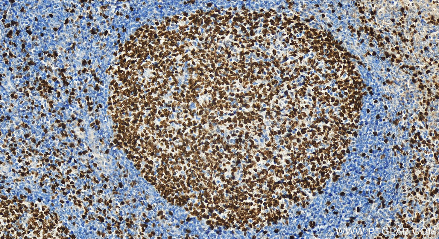 Immunohistochemistry (IHC) staining of human tonsillitis tissue using Ki-67 Polyclonal antibody (32270-1-AP)