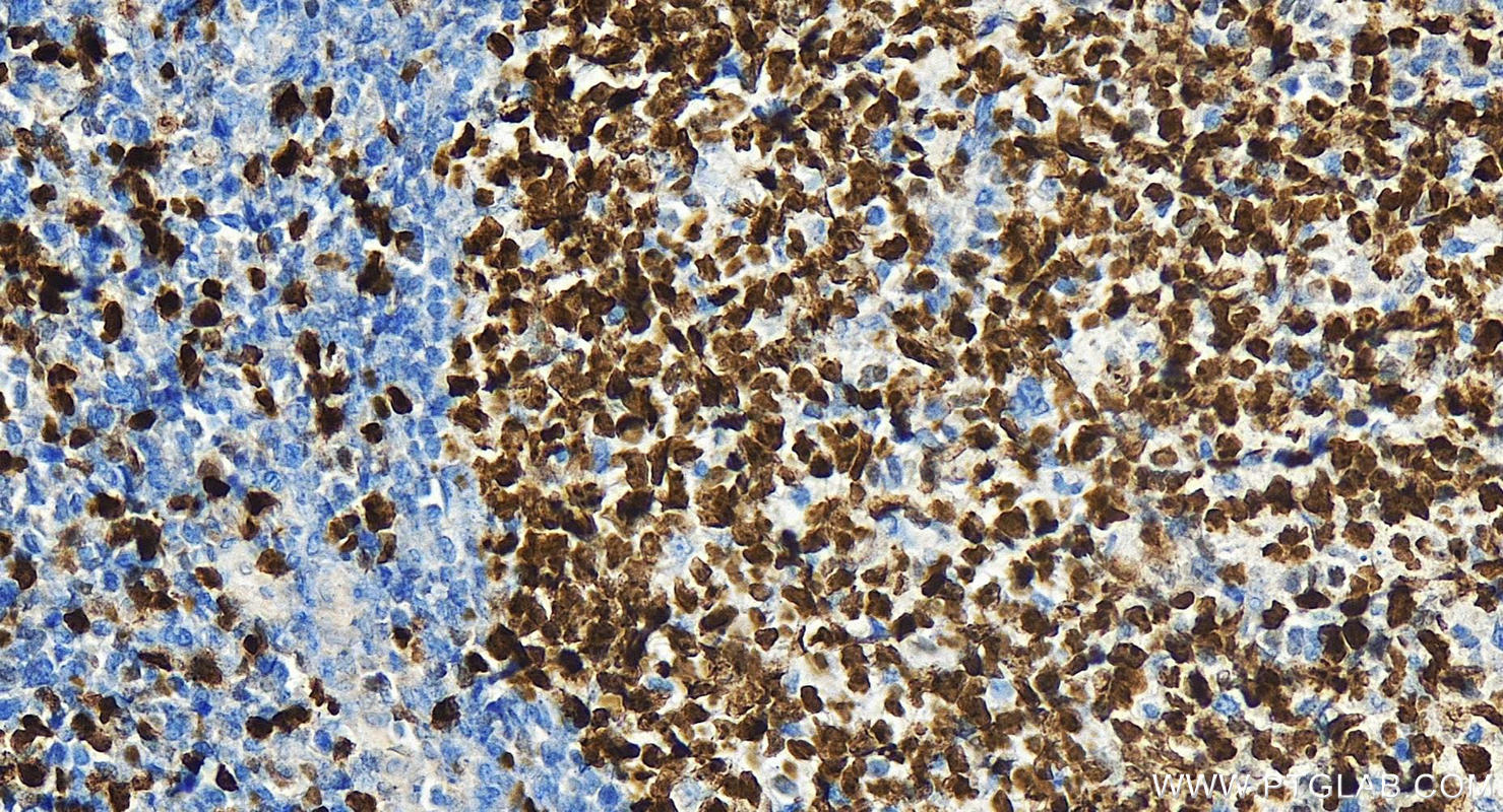 Immunohistochemistry (IHC) staining of human tonsillitis tissue using Ki-67 Polyclonal antibody (32270-1-AP)