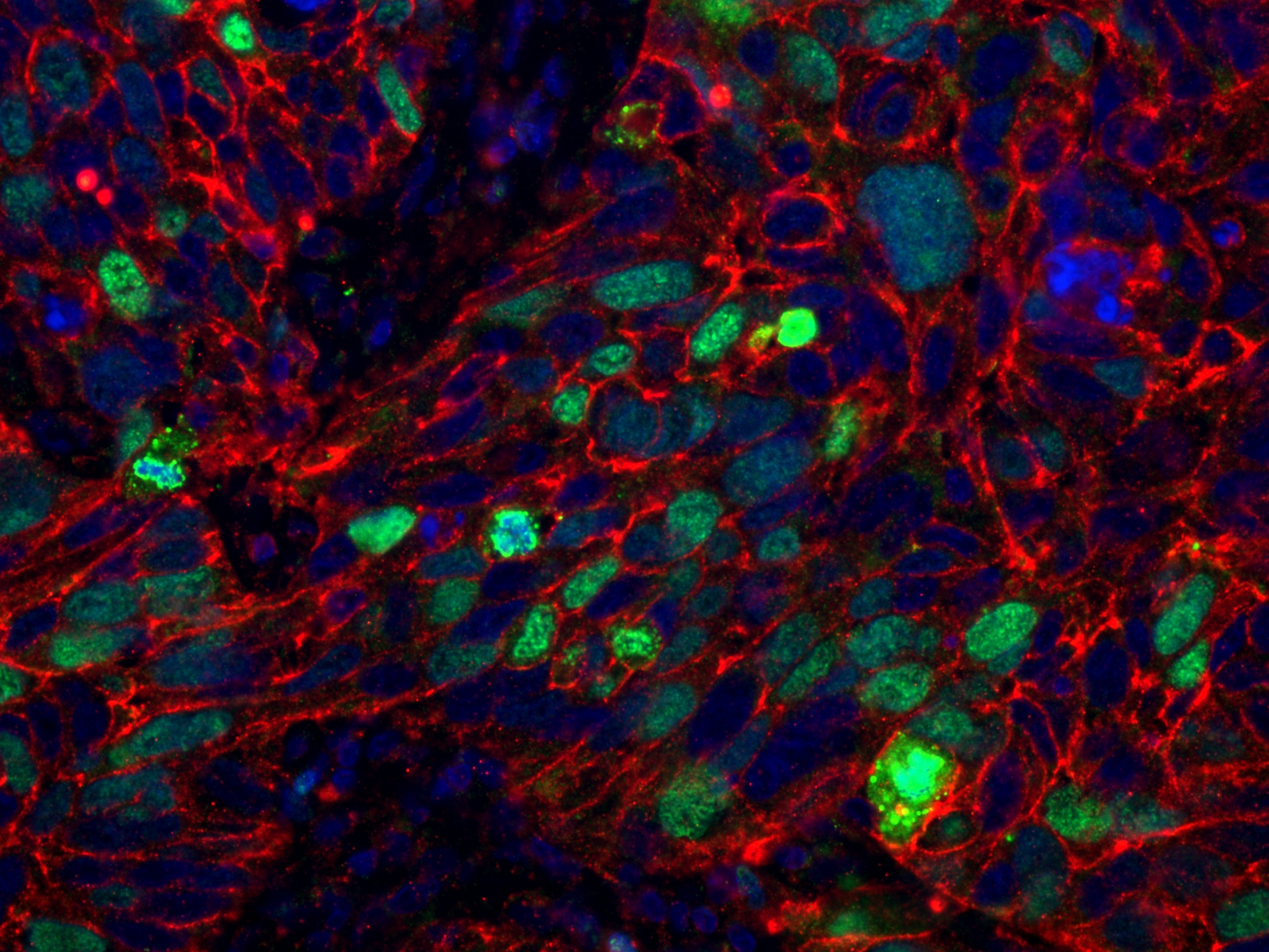 Immunofluorescence (IF) / fluorescent staining of human lung cancer tissue using Ki-67 Recombinant antibody (84192-4-RR)