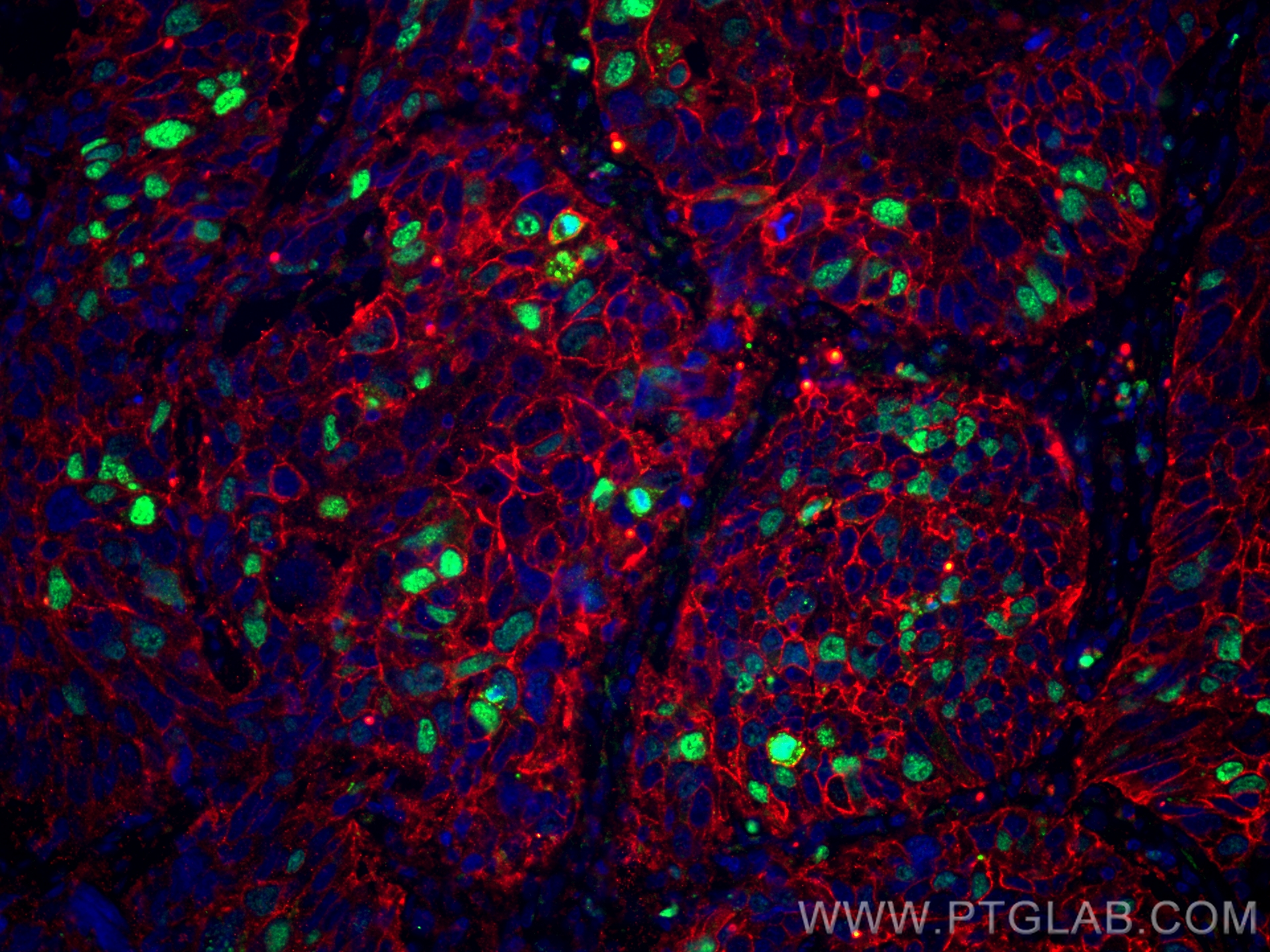 Immunofluorescence (IF) / fluorescent staining of human lung cancer tissue using Ki-67 Recombinant antibody (84192-4-RR)