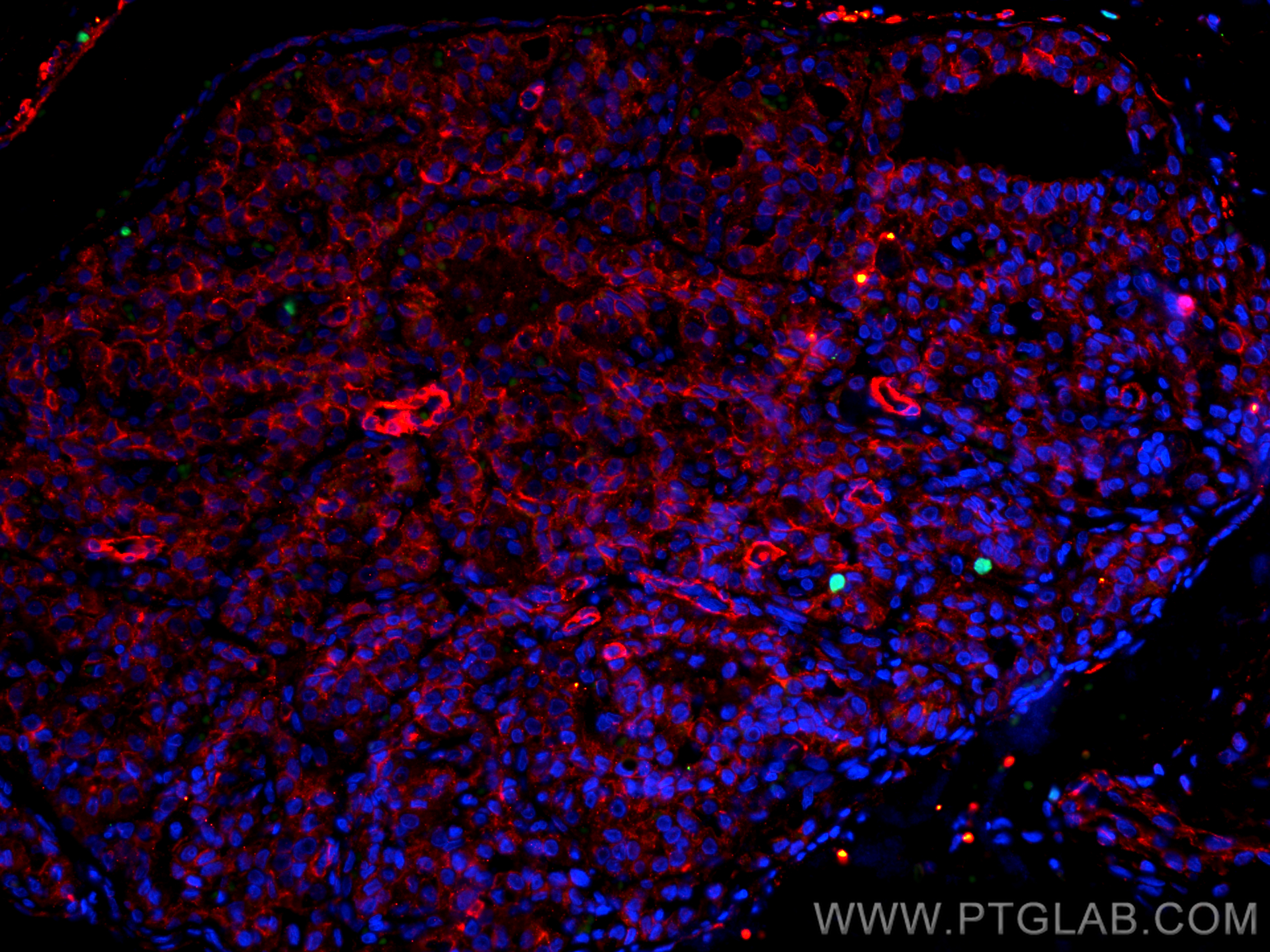 Immunofluorescence (IF) / fluorescent staining of human thyroid cancer tissue using Ki-67 Recombinant antibody (84192-4-RR)