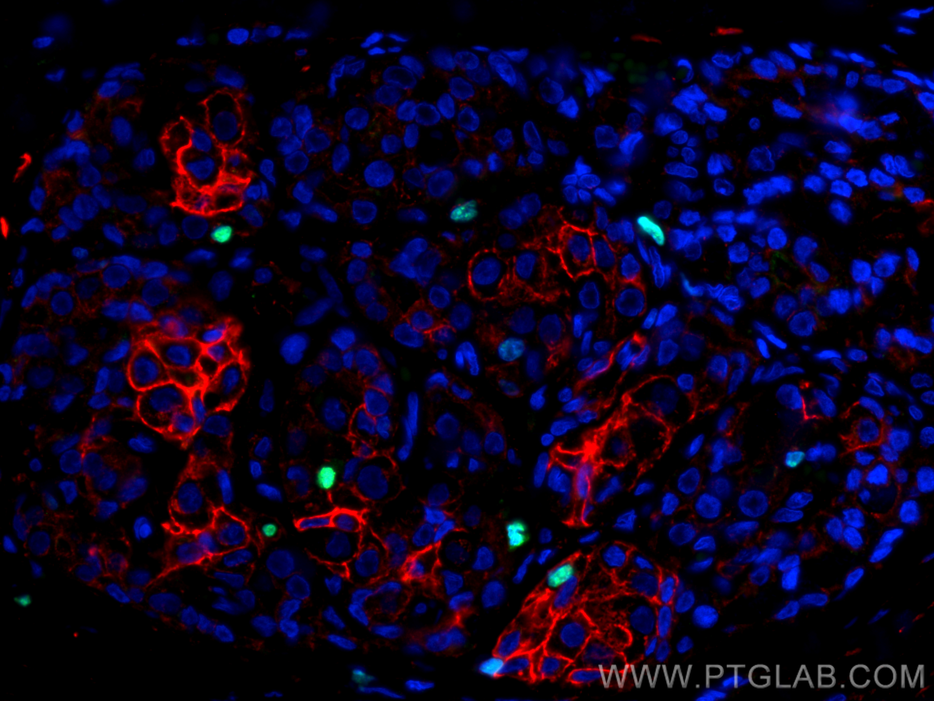 Immunofluorescence (IF) / fluorescent staining of human thyroid cancer tissue using Ki-67 Recombinant antibody (84192-4-RR)