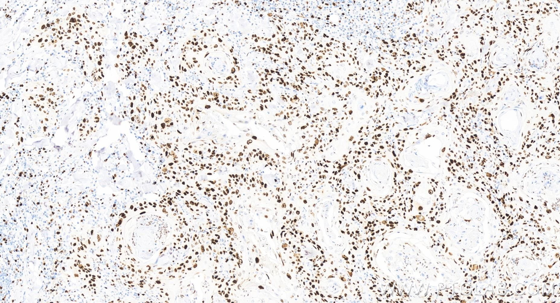 Immunohistochemistry (IHC) staining of human skin cancer tissue using Ki-67 Recombinant antibody (84192-4-RR)