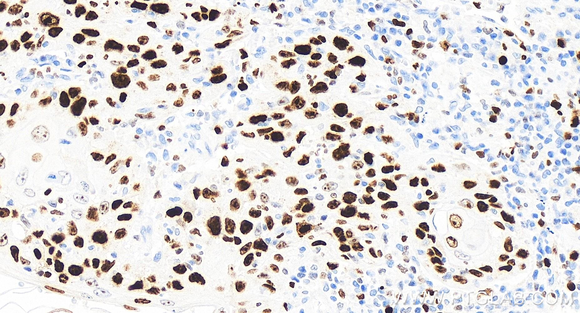 Immunohistochemistry (IHC) staining of human skin cancer tissue using Ki-67 Recombinant antibody (84192-4-RR)