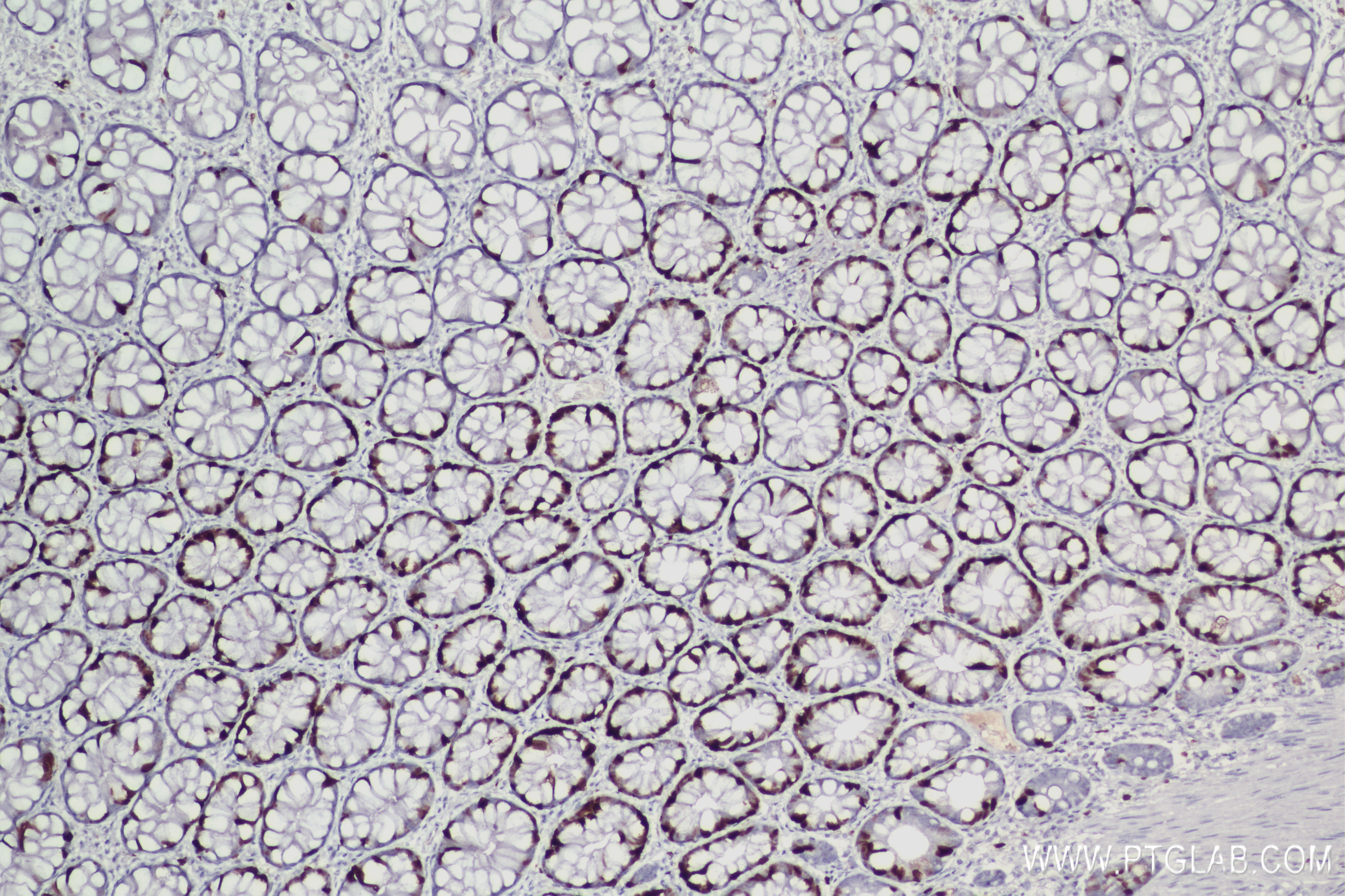 Immunohistochemistry (IHC) staining of Human Rectal cancer tissue using Ki-67 Recombinant antibody (84192-4-RR)