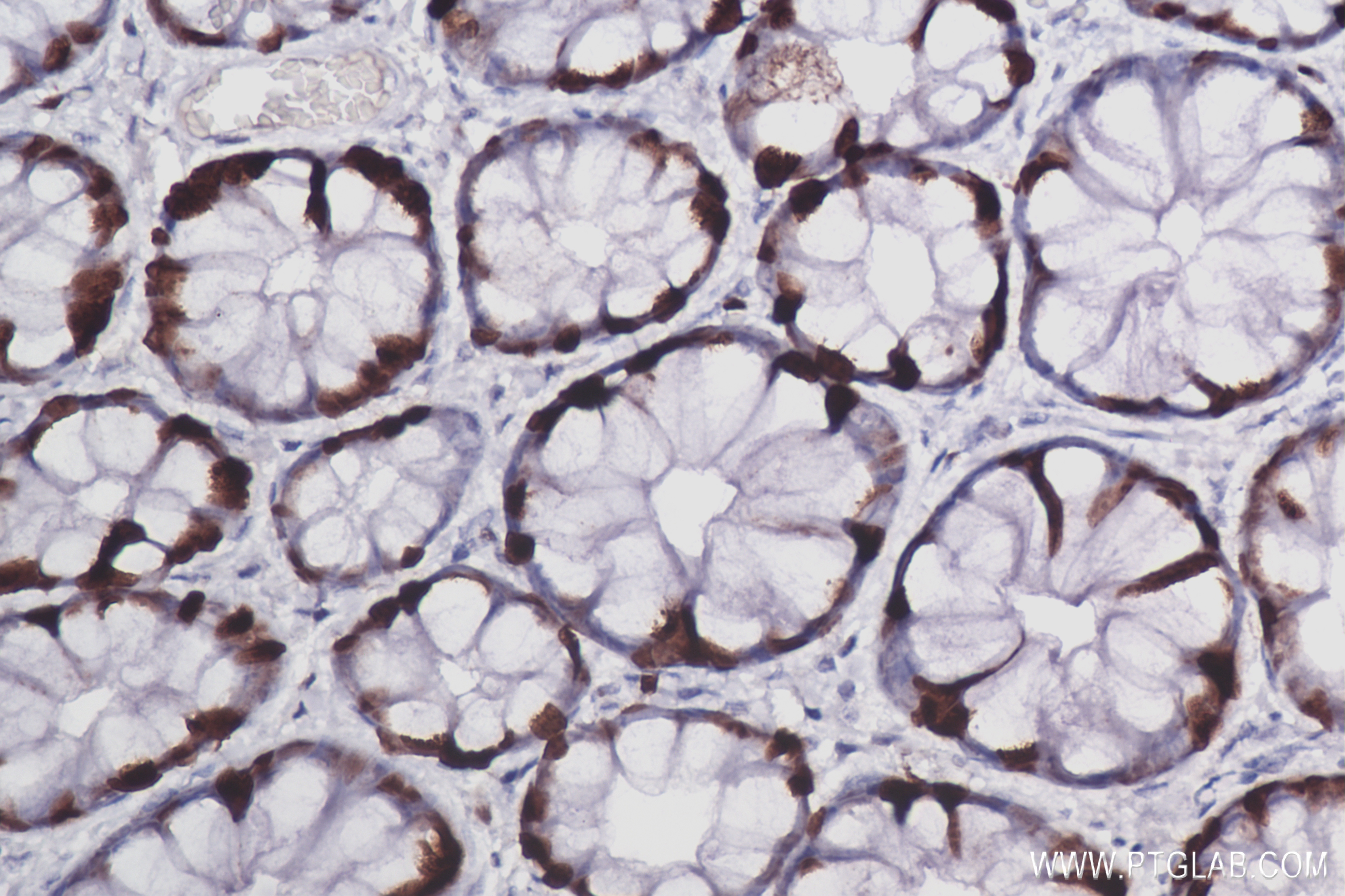 Immunohistochemistry (IHC) staining of Human Rectal cancer tissue using Ki-67 Recombinant antibody (84192-4-RR)