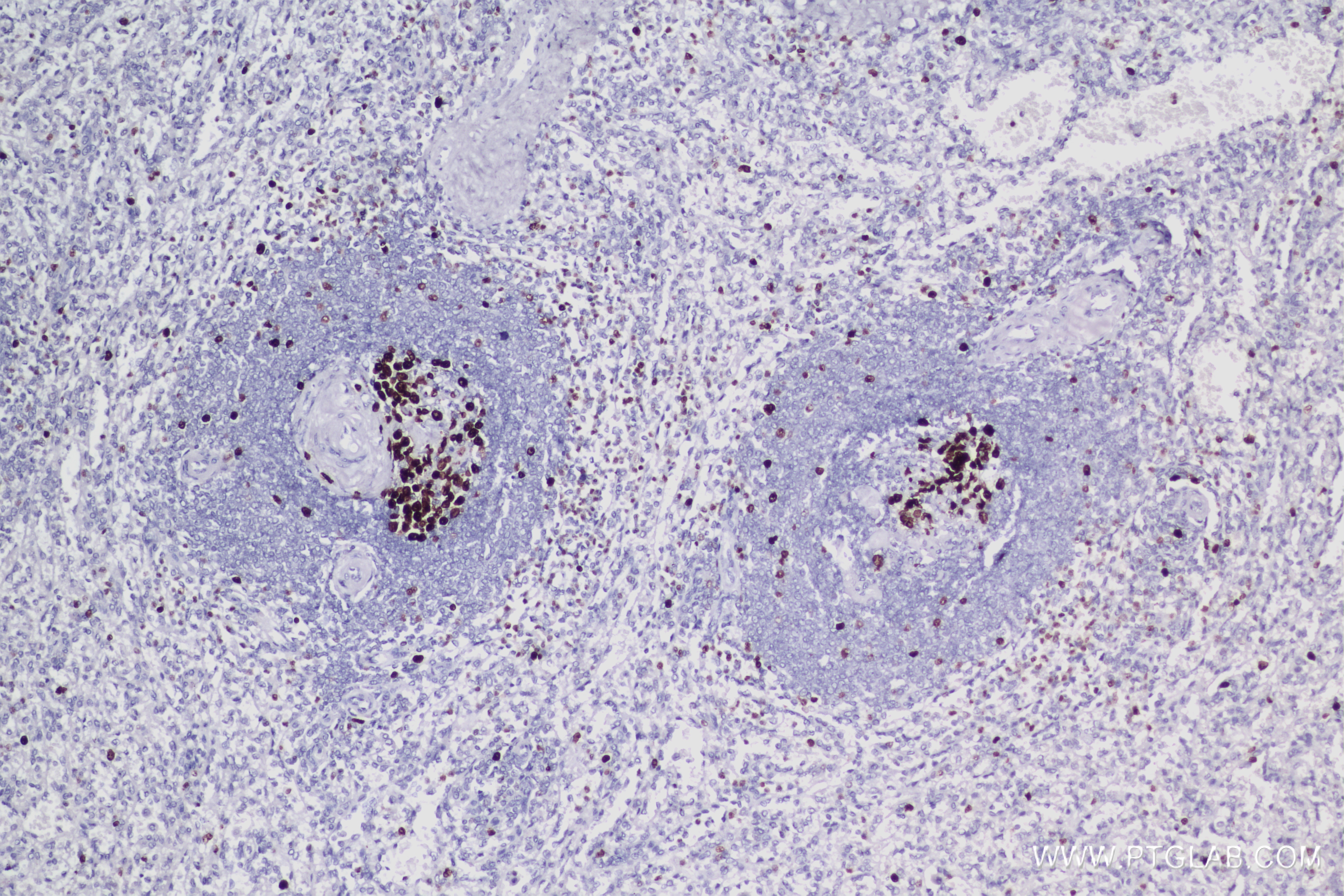 Immunohistochemistry (IHC) staining of Human Spleen tissue using Ki-67 Recombinant antibody (84192-4-RR)