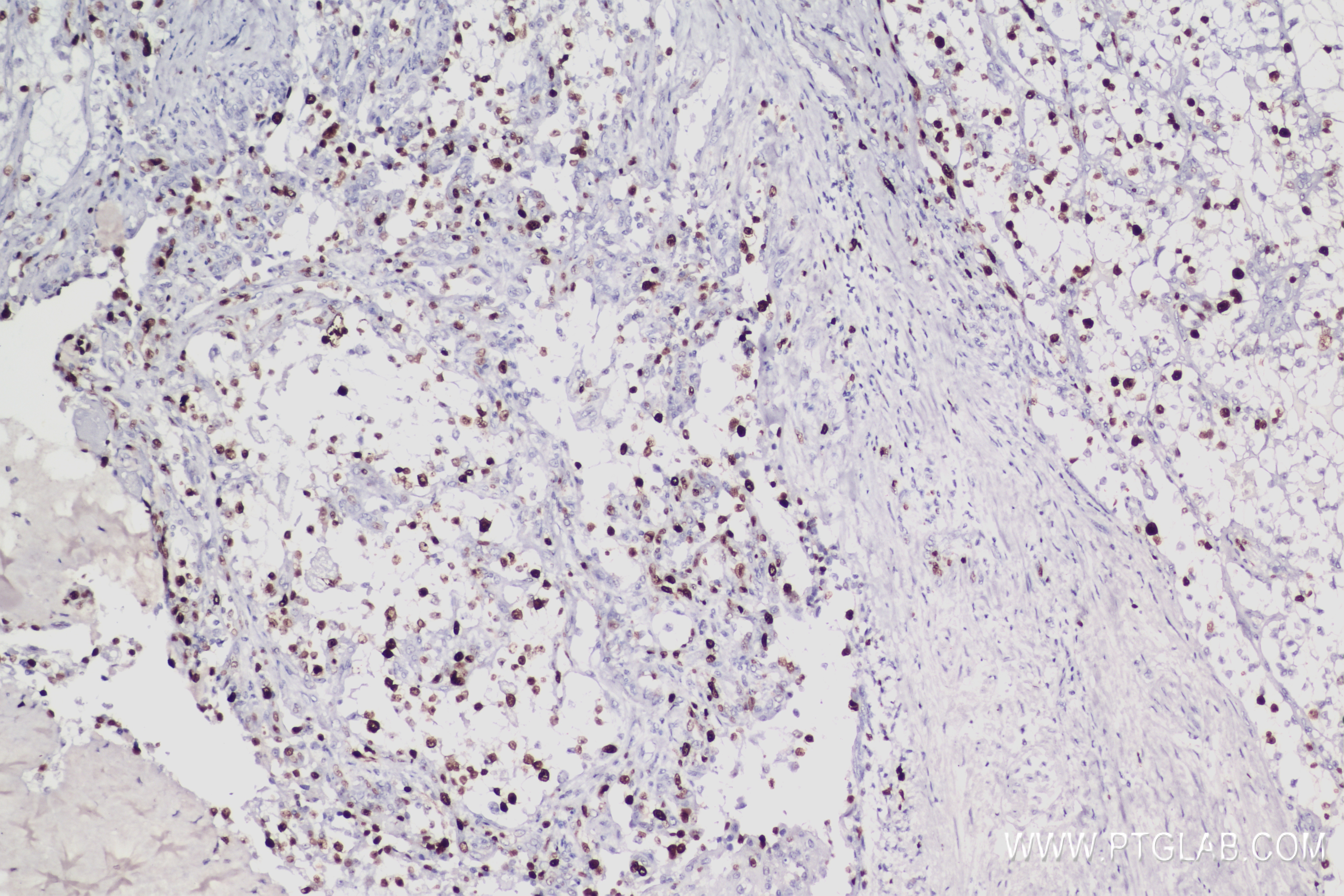 Immunohistochemistry (IHC) staining of Human renal cancer using Ki-67 Recombinant antibody (84192-4-RR)