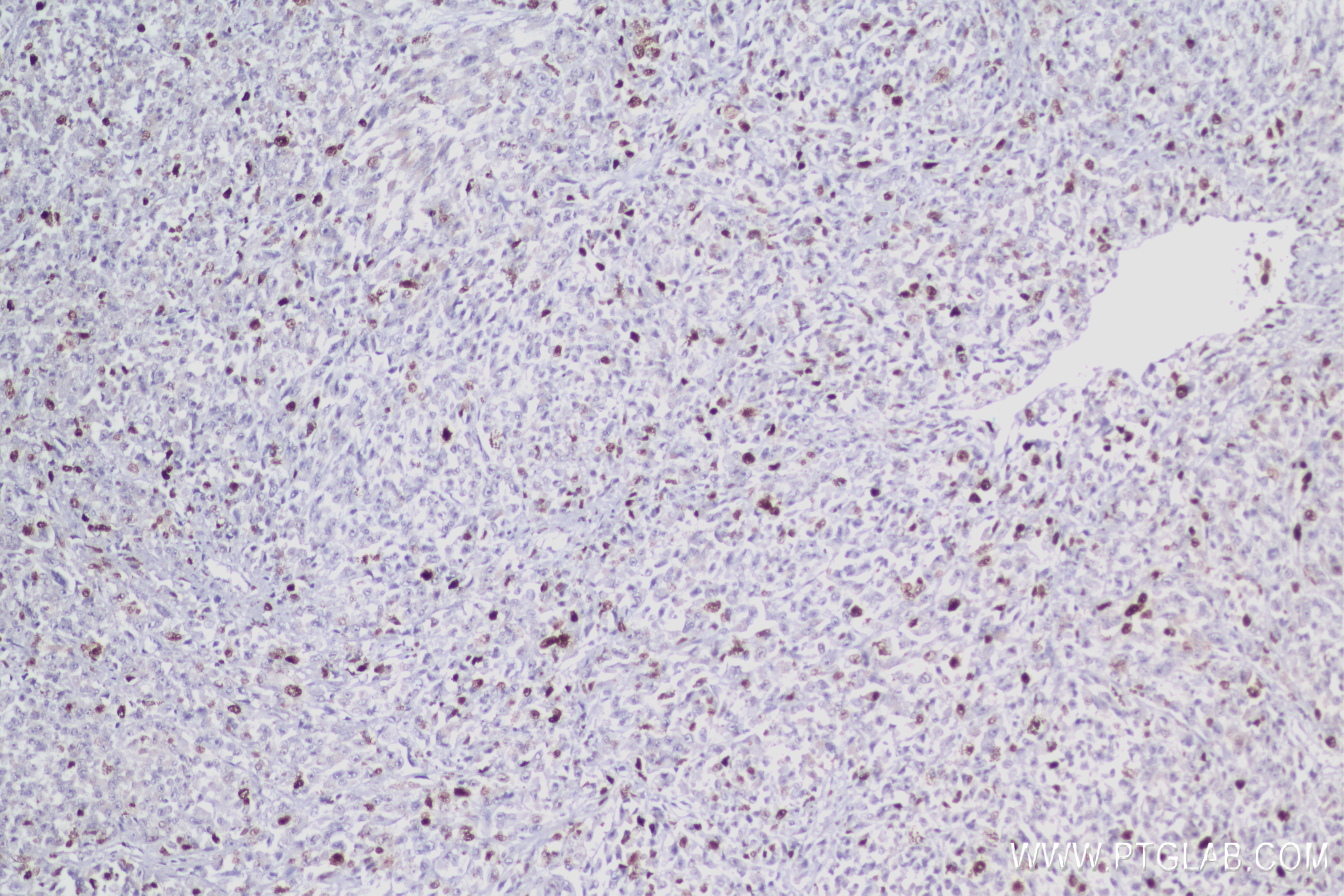 Immunohistochemistry (IHC) staining of human malignant melanoma tissue using Ki-67 Recombinant antibody (84192-4-RR)