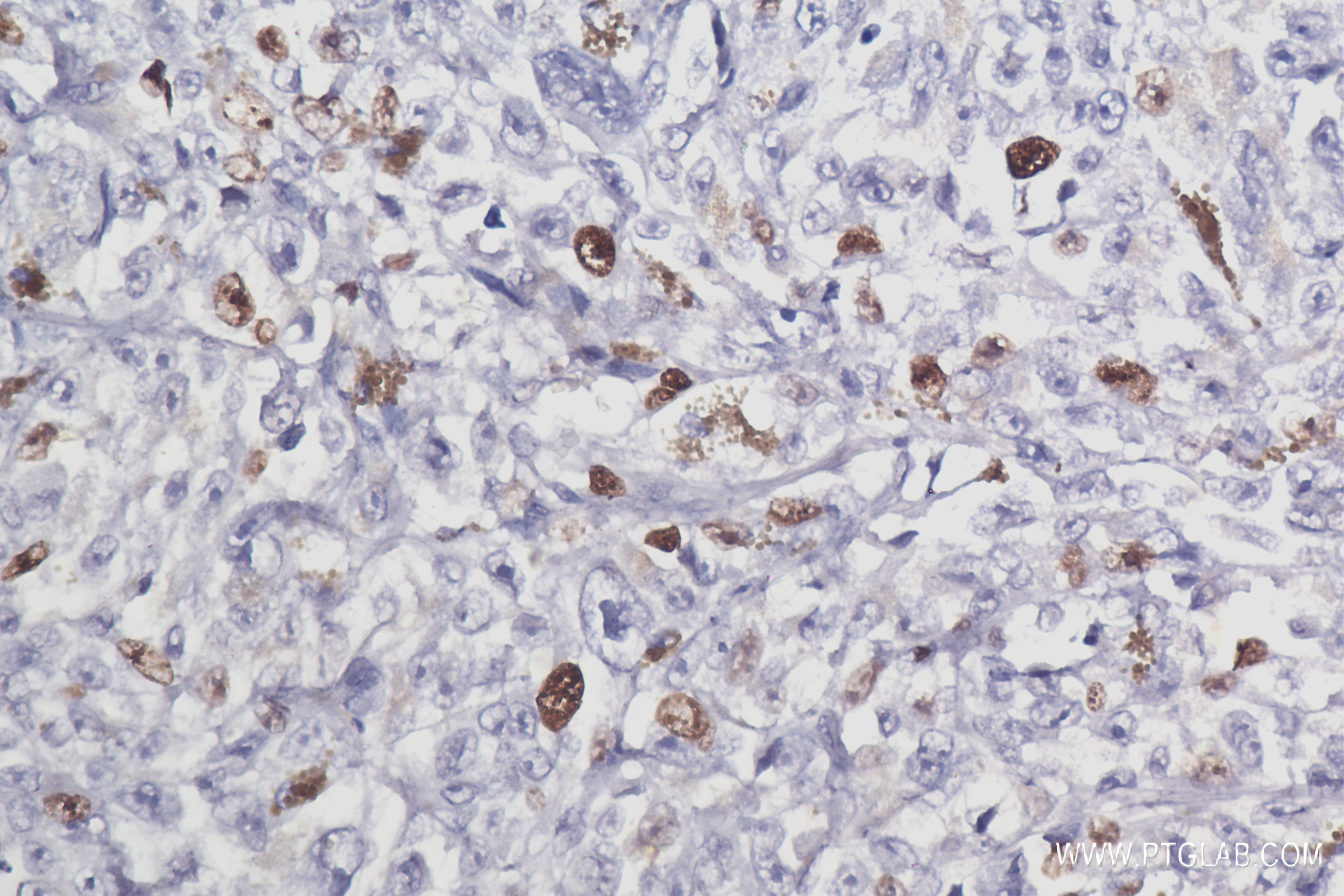 Immunohistochemistry (IHC) staining of human malignant melanoma tissue using Ki-67 Recombinant antibody (84192-4-RR)