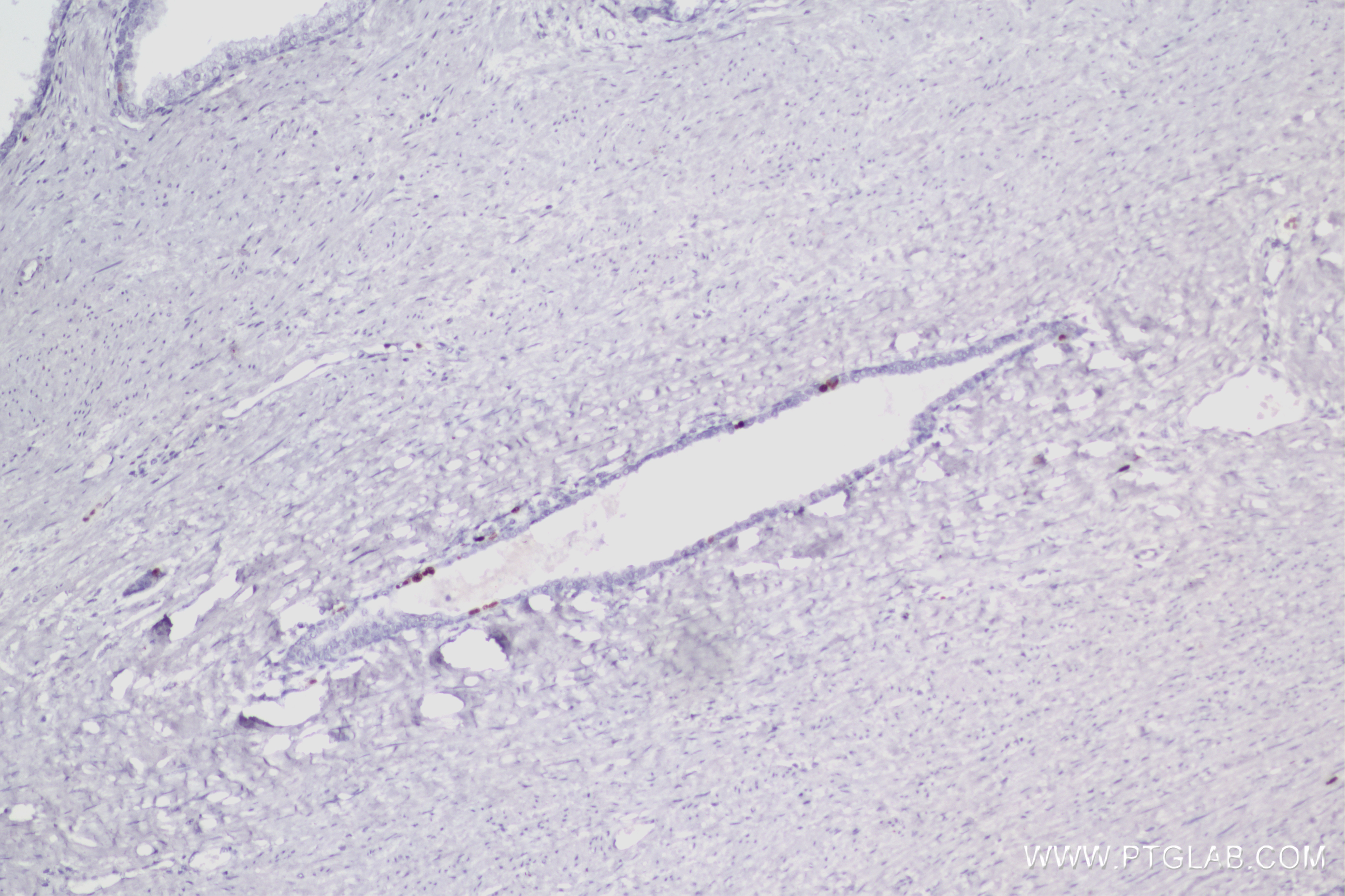 Immunohistochemistry (IHC) staining of human prostate cancer tissue using Ki-67 Recombinant antibody (84192-4-RR)