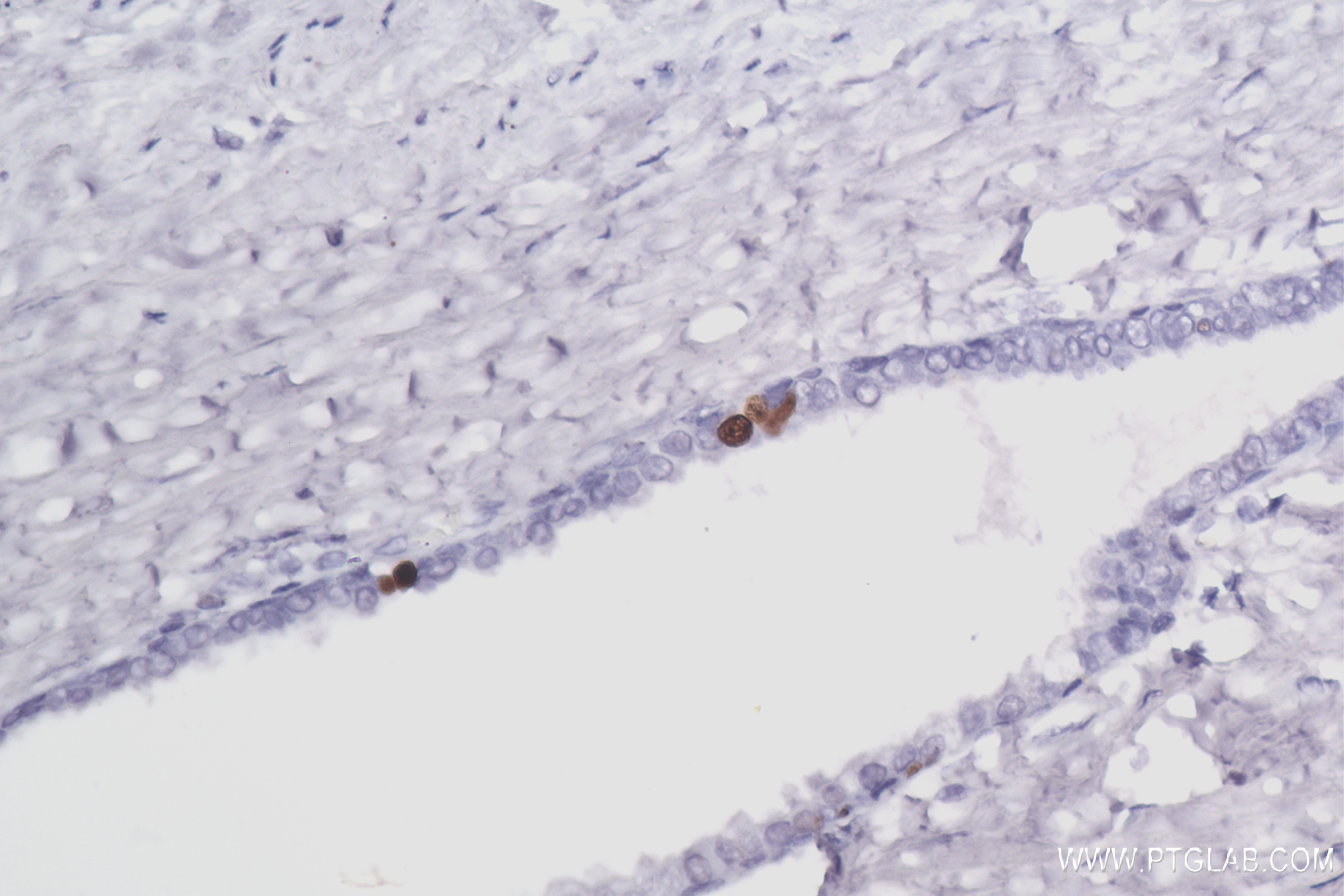 Immunohistochemistry (IHC) staining of human prostate cancer tissue using Ki-67 Recombinant antibody (84192-4-RR)