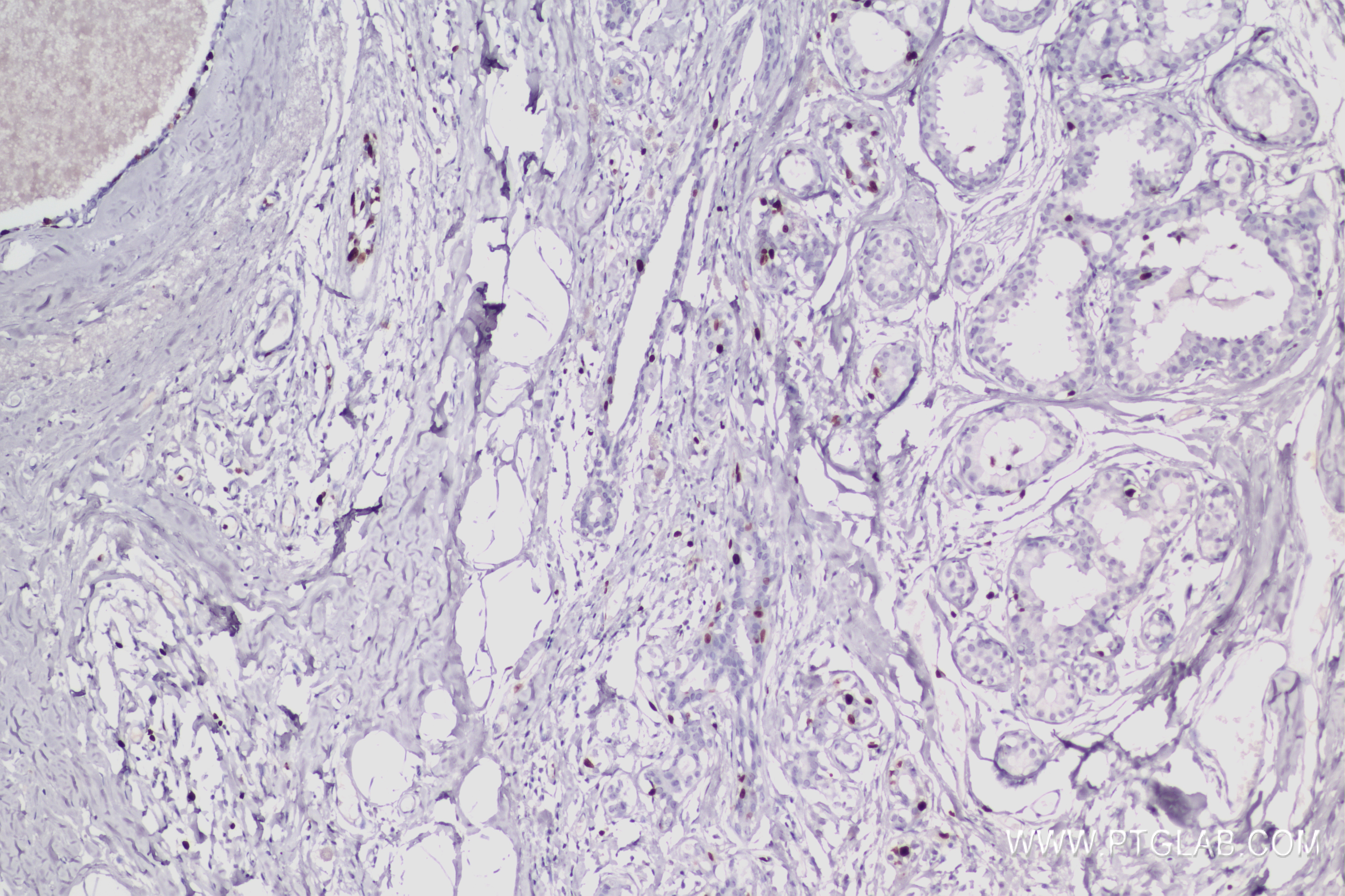 Immunohistochemistry (IHC) staining of human Breast cancer tissue using Ki-67 Recombinant antibody (84192-4-RR)