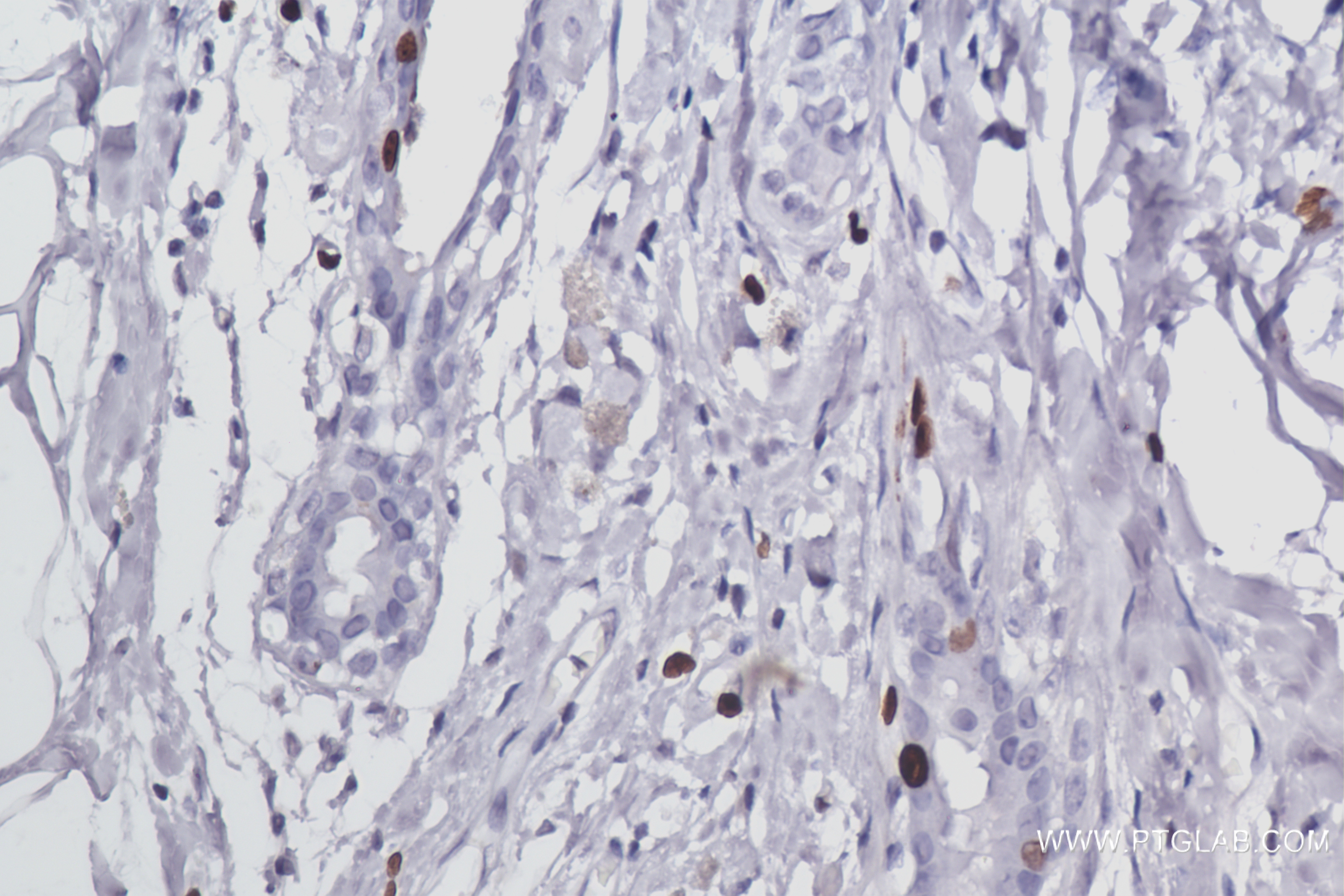 Immunohistochemistry (IHC) staining of human Breast cancer tissue using Ki-67 Recombinant antibody (84192-4-RR)