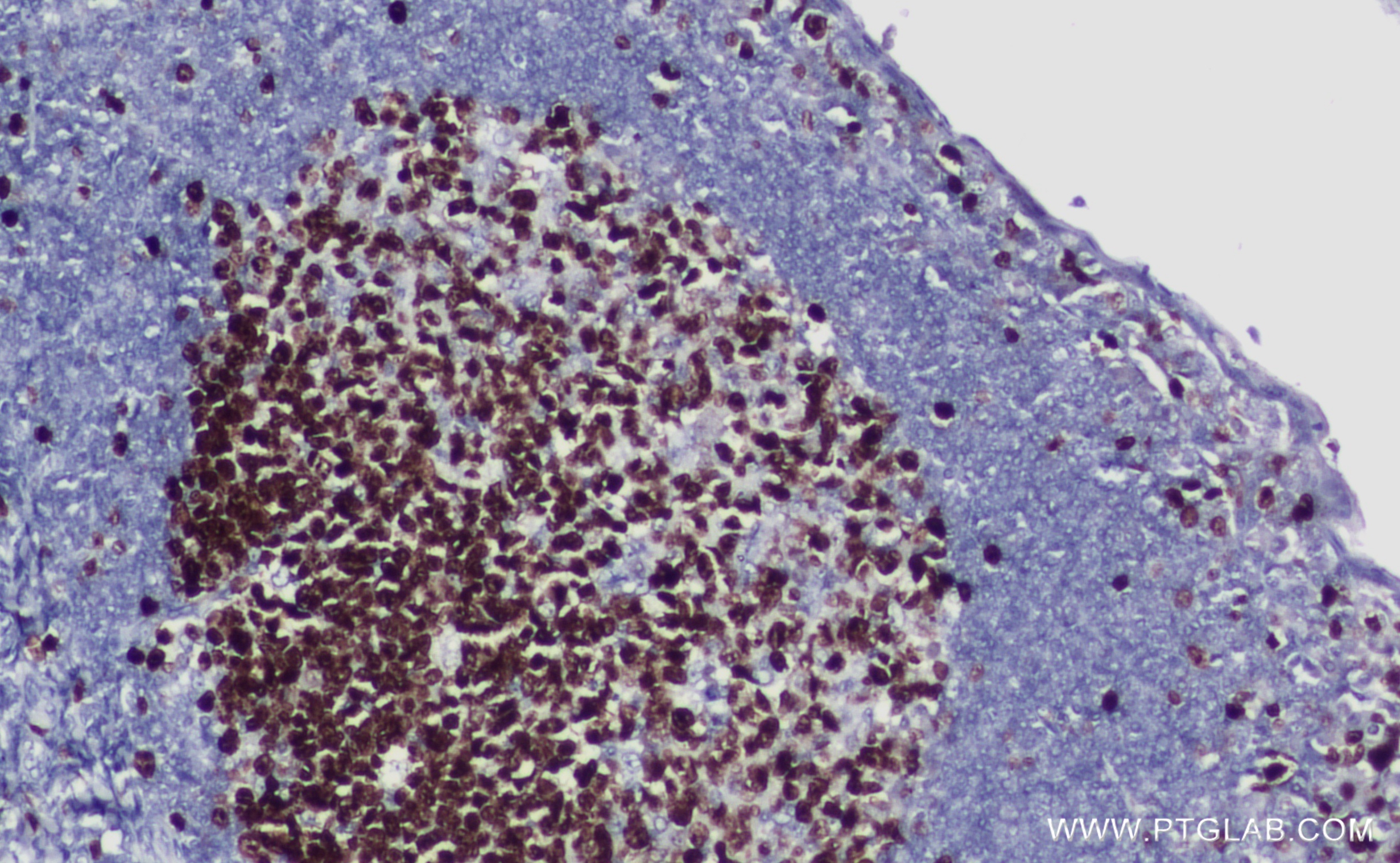 Immunohistochemistry (IHC) staining of human tonsillitis tissue using Ki-67 Recombinant antibody (84192-4-RR)