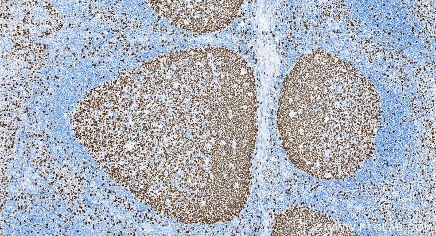 Immunohistochemistry (IHC) staining of human tonsillitis tissue using Ki-67 Recombinant antibody (84192-4-RR)