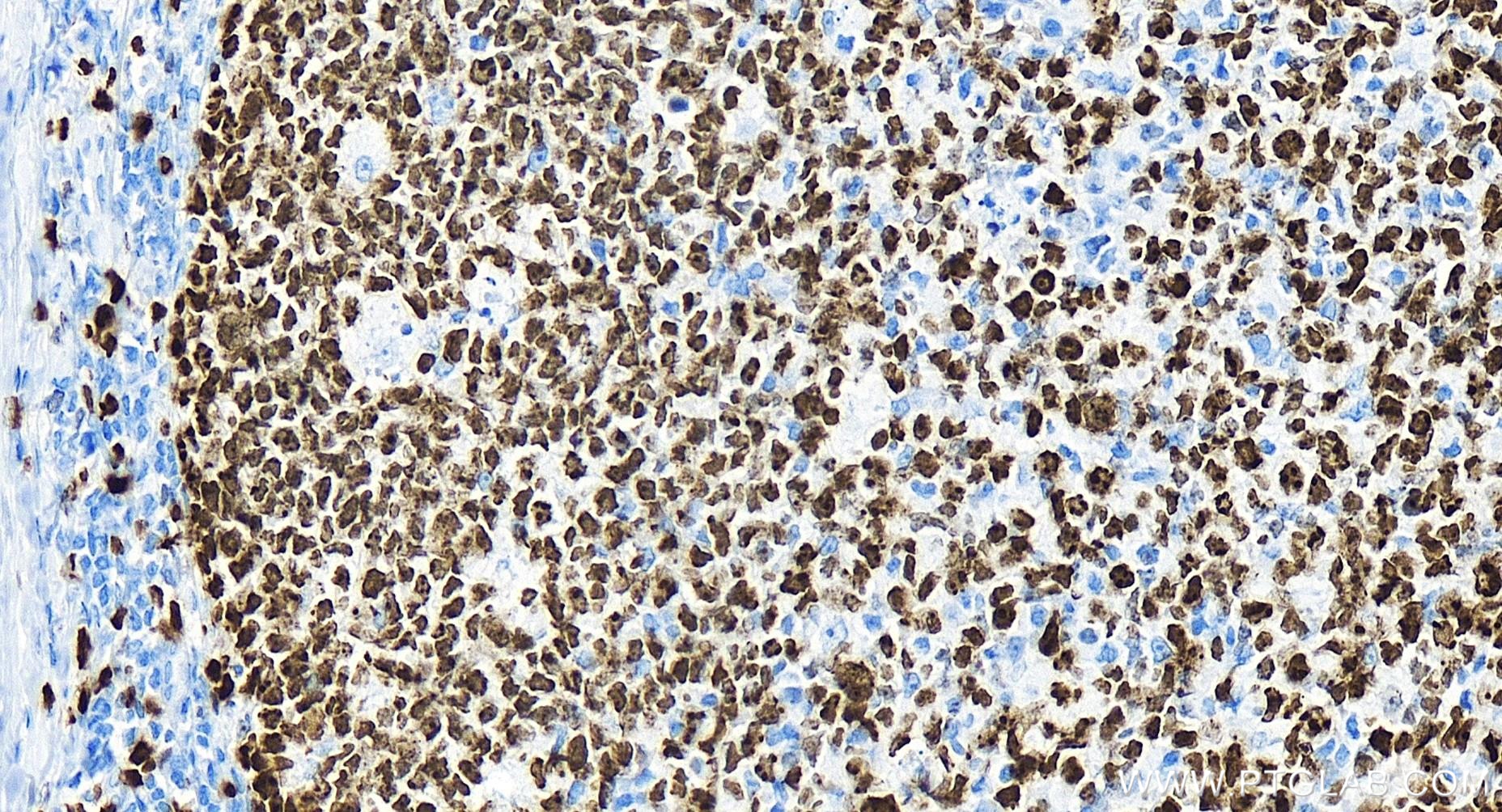 Immunohistochemistry (IHC) staining of human tonsillitis tissue using Ki-67 Recombinant antibody (84192-4-RR)