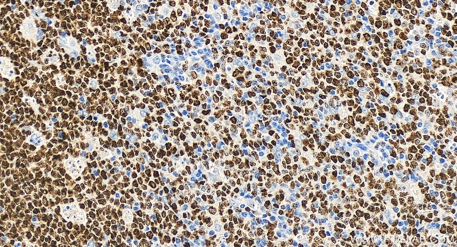 Immunohistochemistry (IHC) staining of human tonsillitis tissue using Biotin-conjugated Ki-67 Recombinant antibody (Biotin-84192-4)