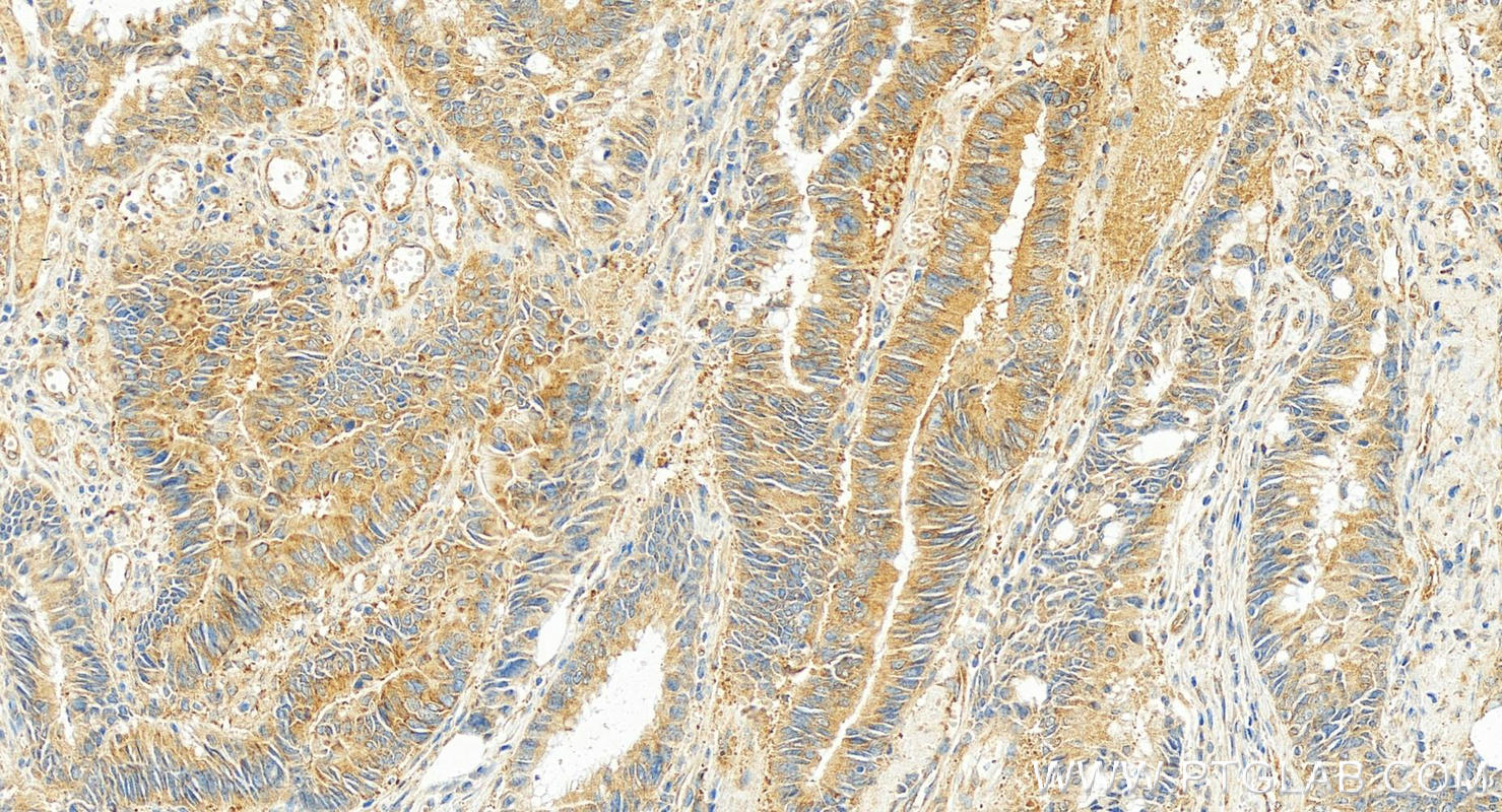 Immunohistochemistry (IHC) staining of human colon cancer tissue using L1CAM Monoclonal antibody (67115-1-Ig)