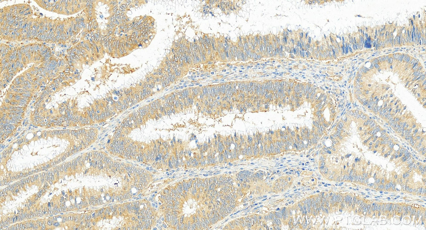 Immunohistochemistry (IHC) staining of human colon cancer tissue using L1CAM Monoclonal antibody (67115-1-Ig)