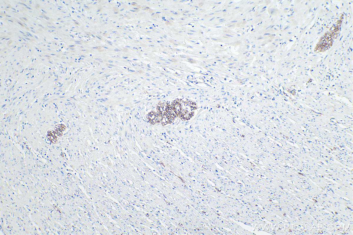 Immunohistochemistry (IHC) staining of human colon tissue using L1CAM Monoclonal antibody (67115-1-Ig)