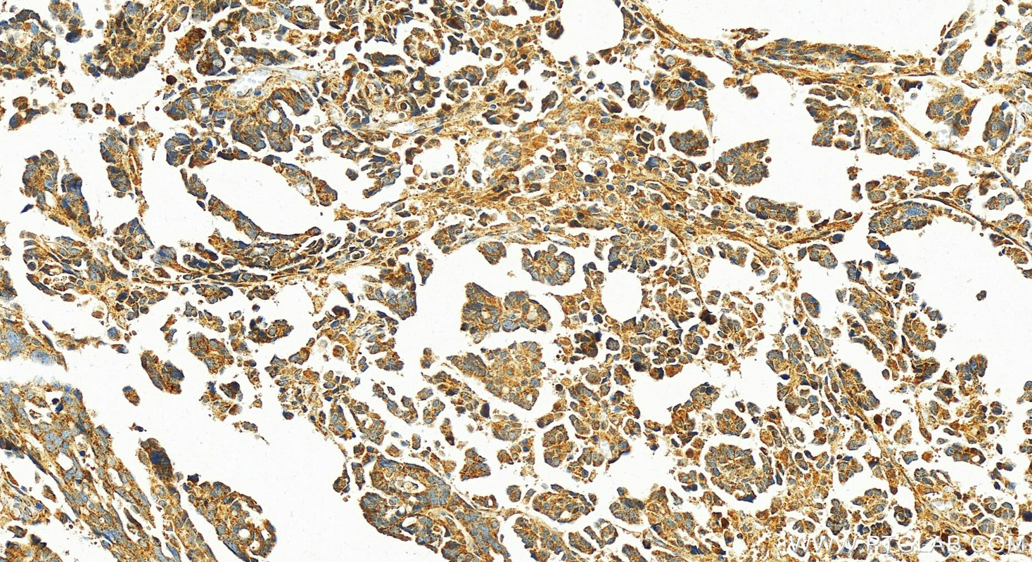 Immunohistochemistry (IHC) staining of human ovary cancer tissue using L1TD1 Polyclonal antibody (21528-1-AP)