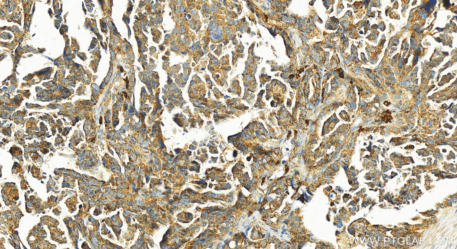 Immunohistochemistry (IHC) staining of human ovary cancer tissue using L1TD1 Polyclonal antibody (21528-1-AP)