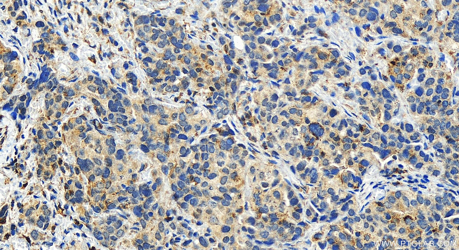 Immunohistochemistry (IHC) staining of human ovary cancer tissue using LACC1 Polyclonal antibody (27895-1-AP)