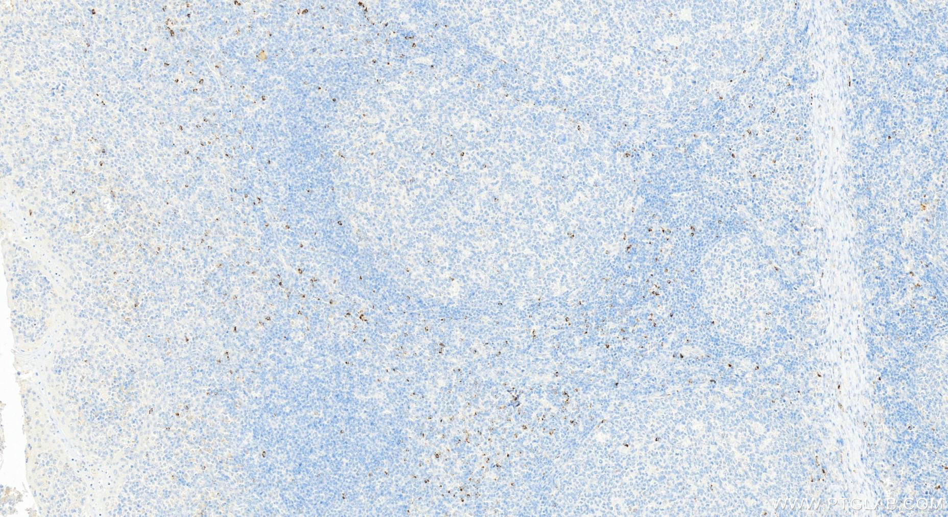 Immunohistochemistry (IHC) staining of human tonsillitis tissue using LAG-3/CD223 Polyclonal antibody (16616-1-AP)