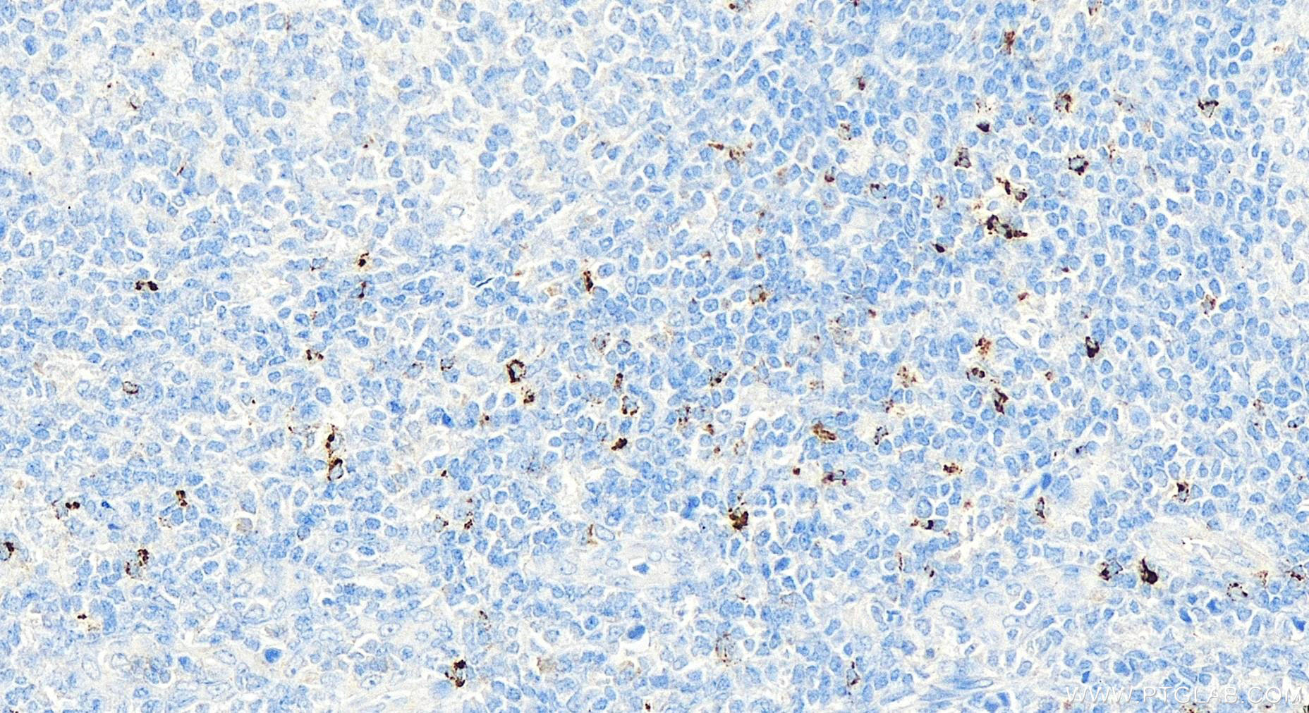 Immunohistochemistry (IHC) staining of human tonsillitis tissue using LAG-3/CD223 Polyclonal antibody (16616-1-AP)