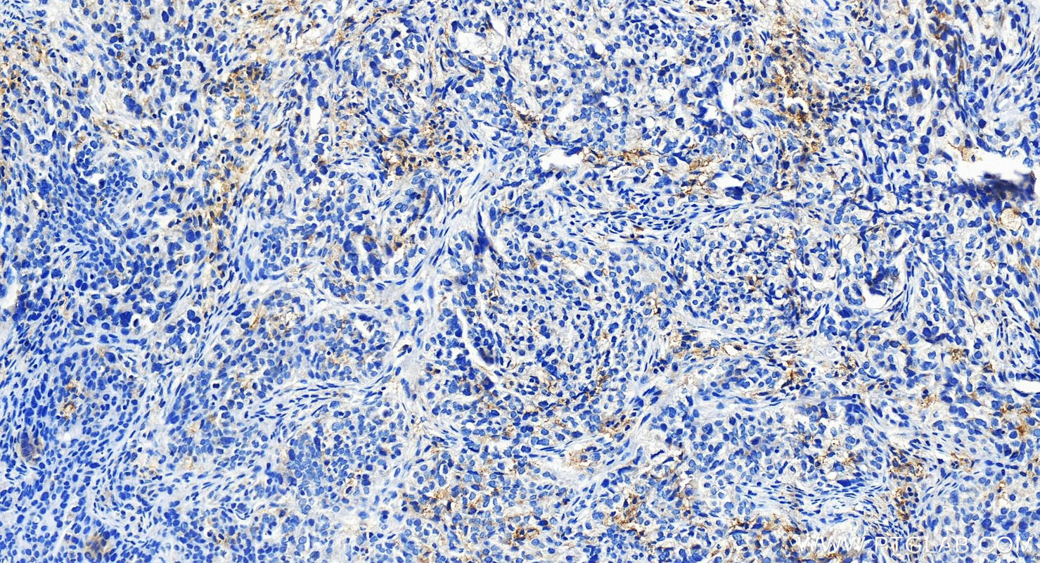 Immunohistochemistry (IHC) staining of human ovary cancer tissue using LAIR1 Polyclonal antibody (13297-1-AP)