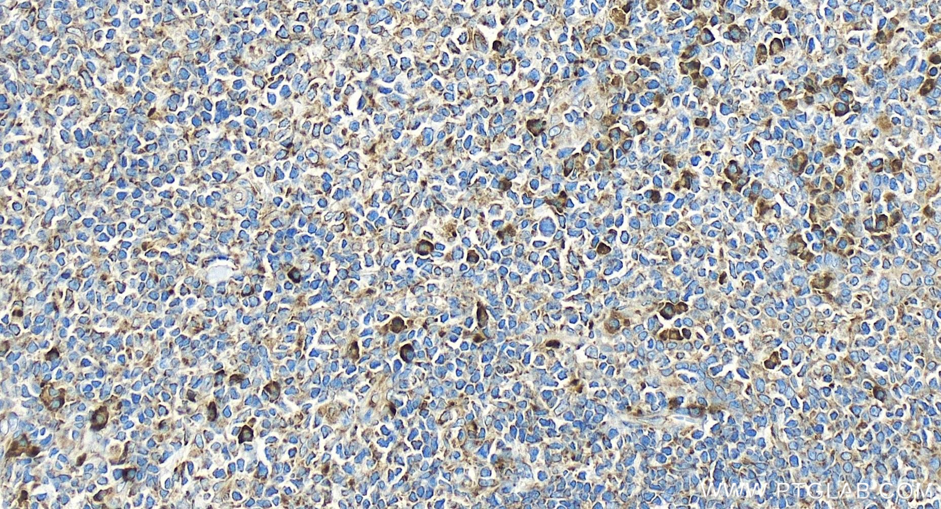 Immunohistochemistry (IHC) staining of human tonsillitis tissue using LAIR1 Recombinant antibody (84677-4-RR)