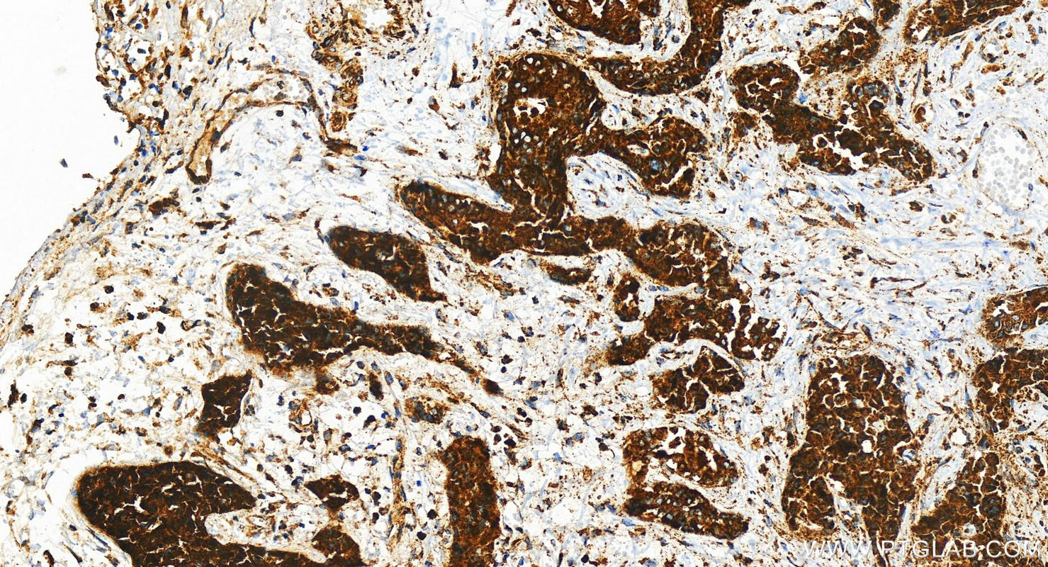 Immunohistochemistry (IHC) staining of human intrahepatic cholangiocarcinoma tissue using LAMA3 Recombinant antibody (83210-2-RR)