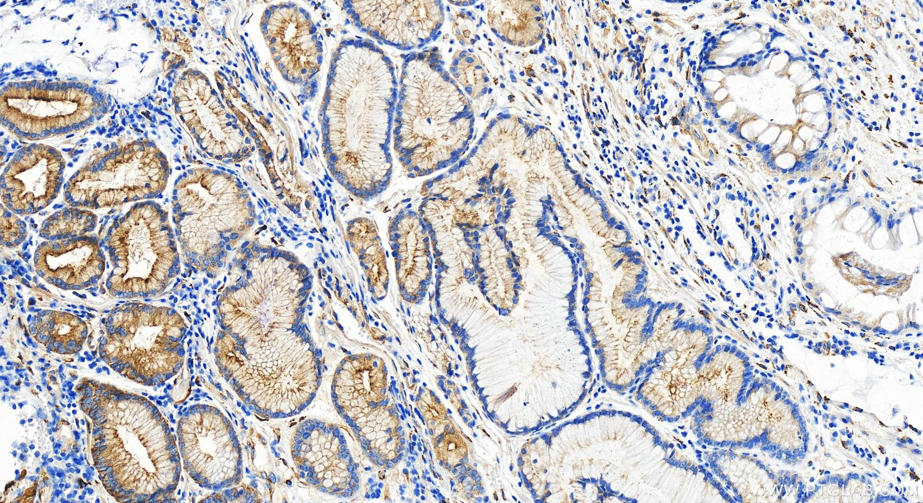 Immunohistochemistry (IHC) staining of human stomach cancer tissue using LAMB2 Polyclonal antibody (30943-1-AP)