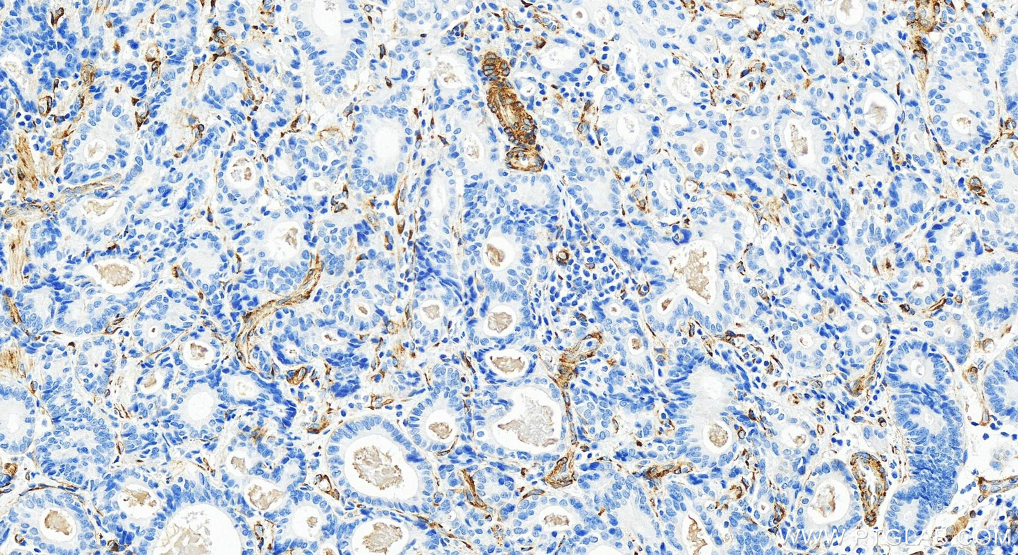 Immunohistochemistry (IHC) staining of human stomach cancer tissue using LAMB2 Recombinant antibody (82946-1-RR)