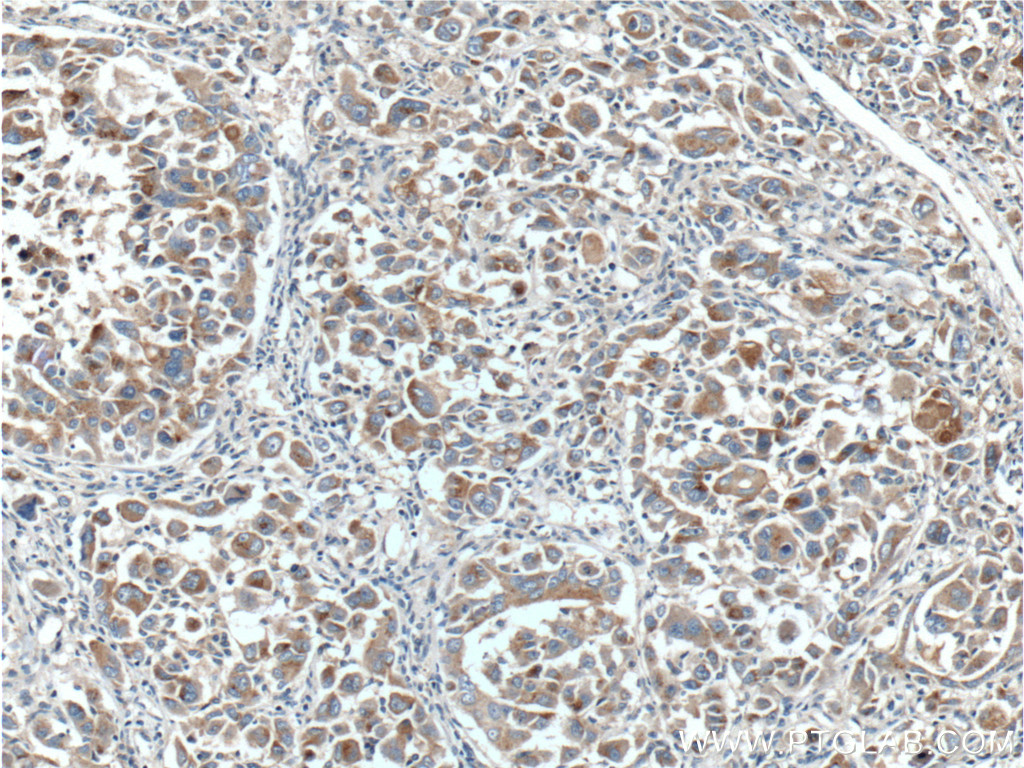 Immunohistochemistry (IHC) staining of human liver cancer tissue using LAPTM4B Polyclonal antibody (18895-1-AP)