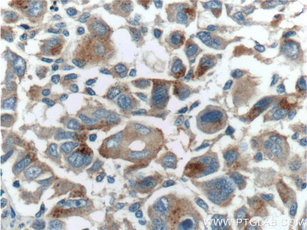 Immunohistochemistry (IHC) staining of human liver cancer tissue using LAPTM4B Polyclonal antibody (18895-1-AP)