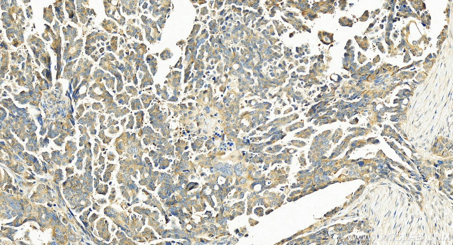 Immunohistochemistry (IHC) staining of human ovary cancer tissue using LARP1 Polyclonal antibody (13708-1-AP)